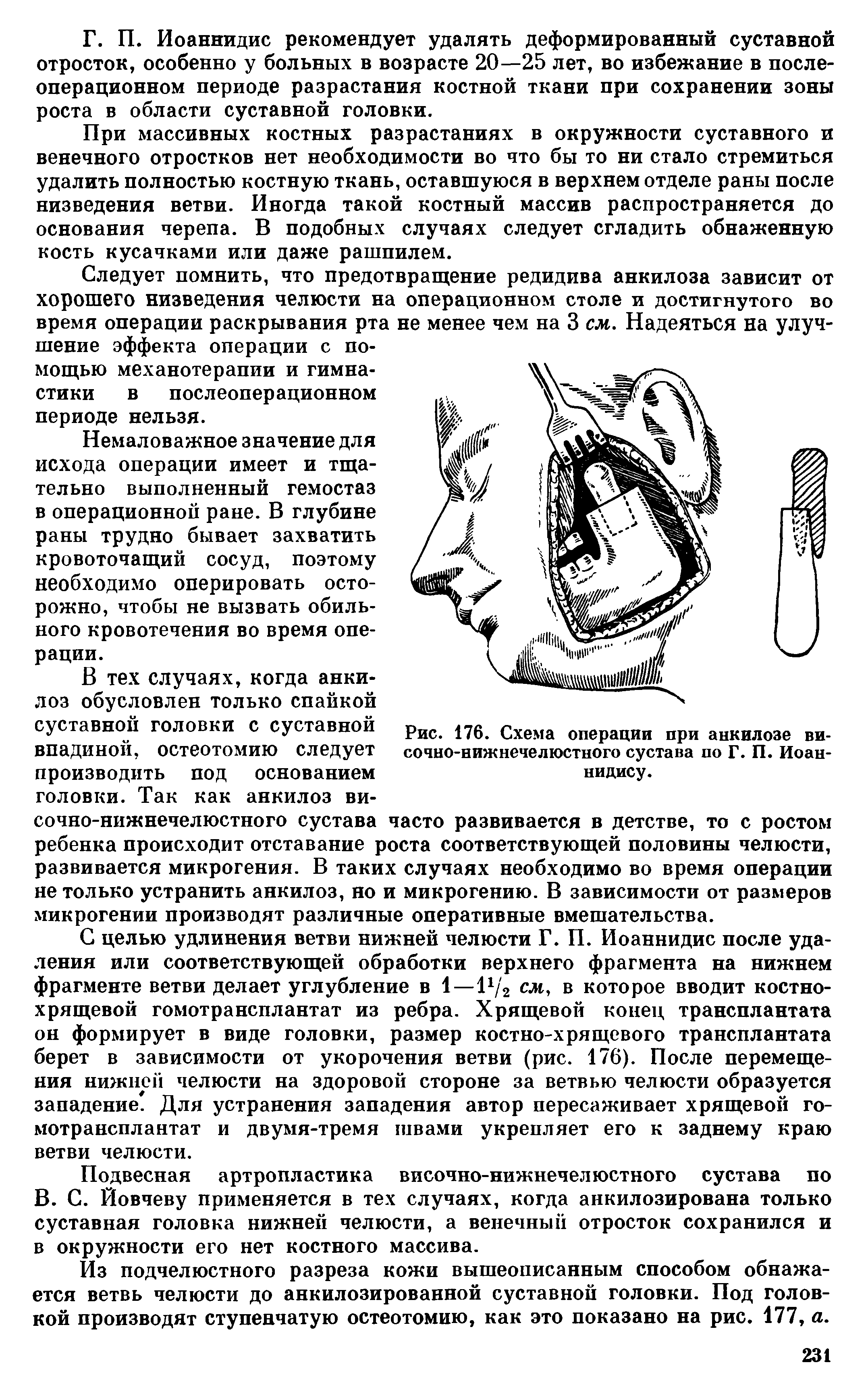 Рис. 176. Схема операции при анкилозе височно-нижнечелюстного сустава по Г. П. Иоан-нидису.