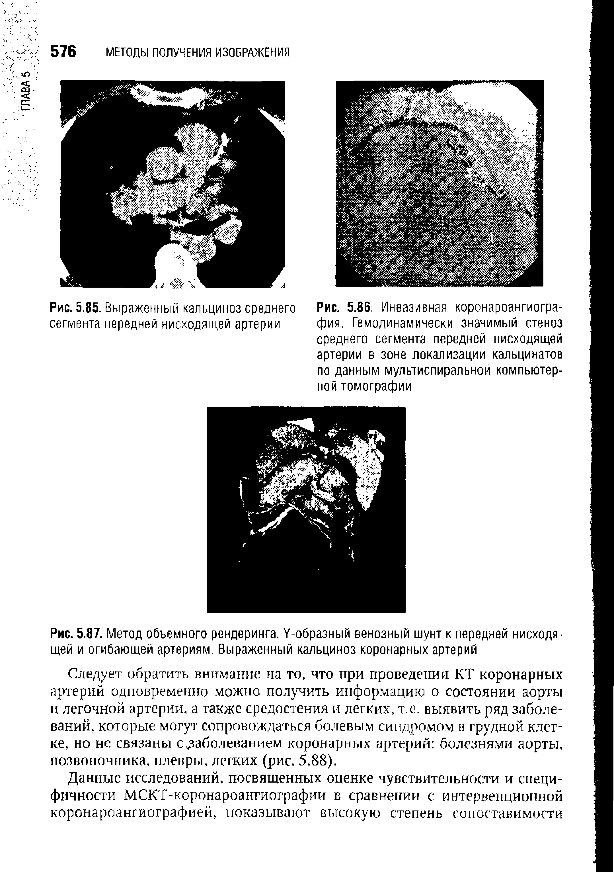 Рис. 5.87. Метод объемного рендеринга. Уобразный венозный шунт к передней нисходящей и огибающей артериям. Выраженный кальциноз коронарных артерий...