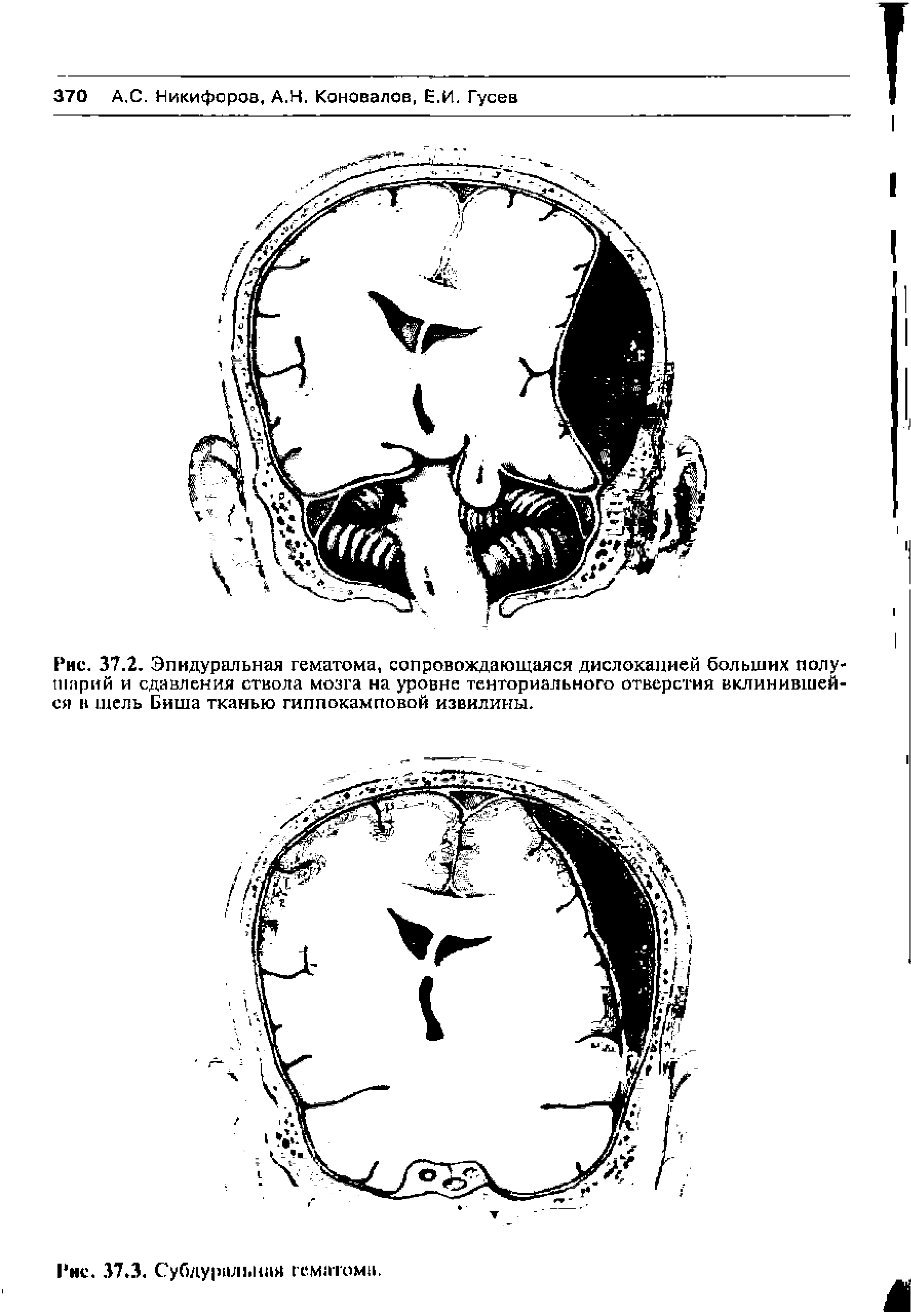Рис. 37.2. Эпидуральная гематома, сопровождающаяся дислокацией больших полушарий и сдавления ствола мозга на уровне тенториального отверстия вклинившейся в щель Биша тканью гиппокамповой извилины.