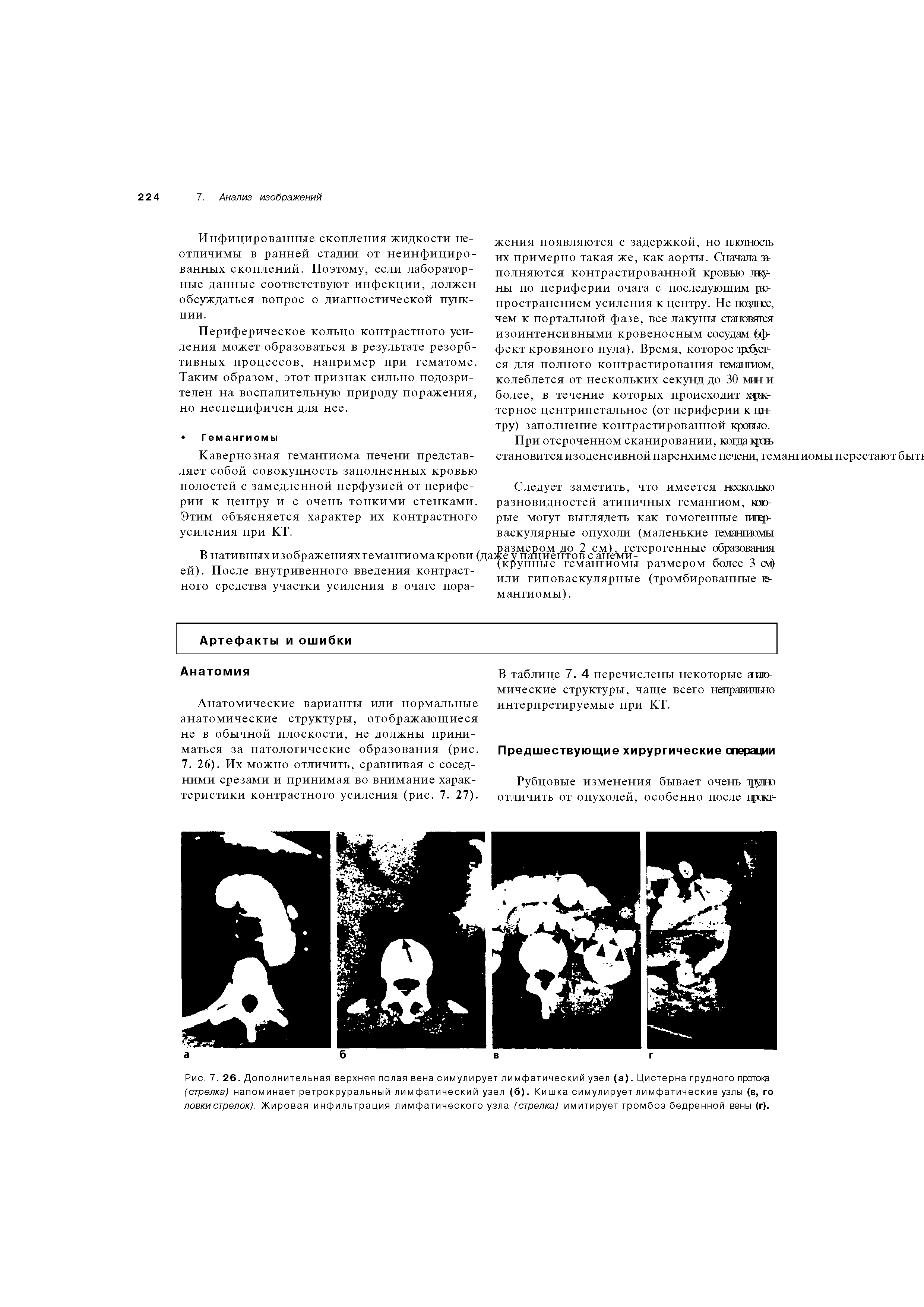 Рис. 7. 26. Дополнительная верхняя полая вена симулирует лимфатический узел (а). Цистерна грудного протока (стрелка) напоминает ретрокруральный лимфатический узел (б). Кишка симулирует лимфатические узлы (в, го ловки стрелок). Жировая инфильтрация лимфатического узла (стрелка) имитирует тромбоз бедренной вены (г).