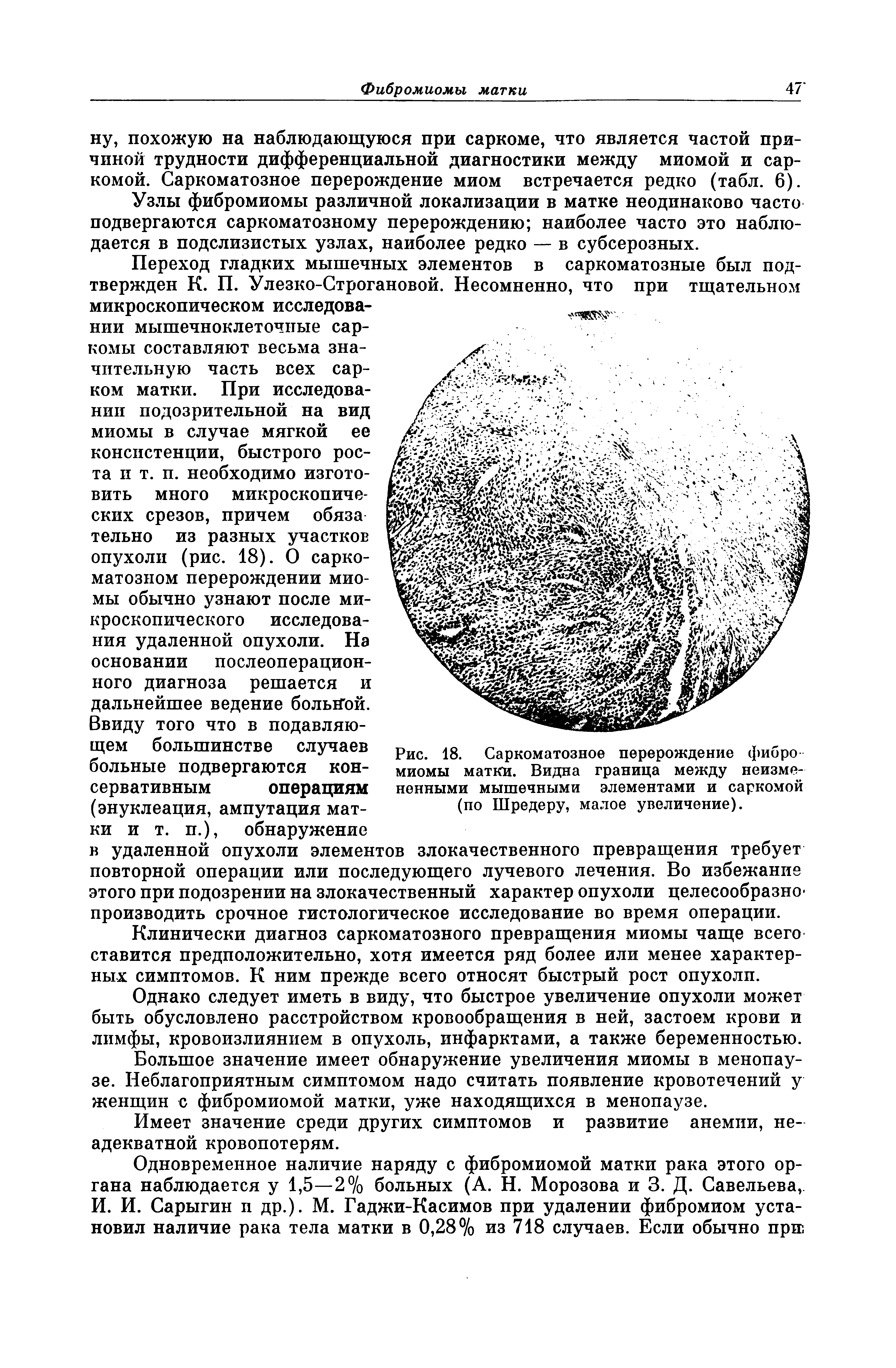 Рис. 18. Саркоматозное перерождение фибро миомы матки. Видна граница между неизмененными мышечными элементами и саркомой (по Шредеру, малое увеличение).