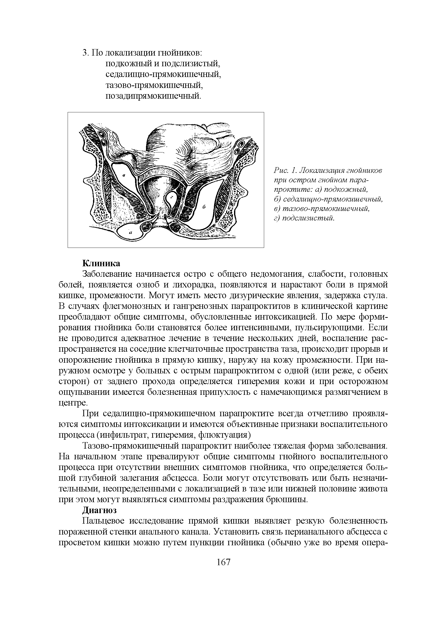 Рис. 1. Локализация гнойников при остром гнойном парапроктите а) подкожный,...