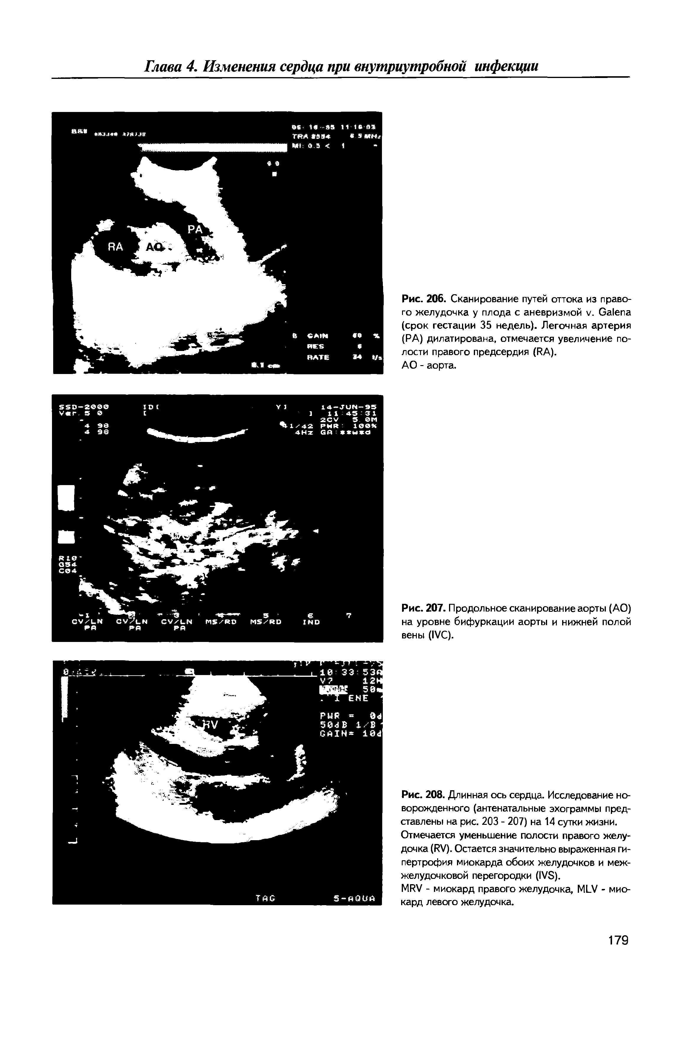 Рис. 208. Длинная ось сердца. Исследование новорожденного (антенатальные эхограммы представлены на рис. 203 - 207) на 14 сутки жизни.