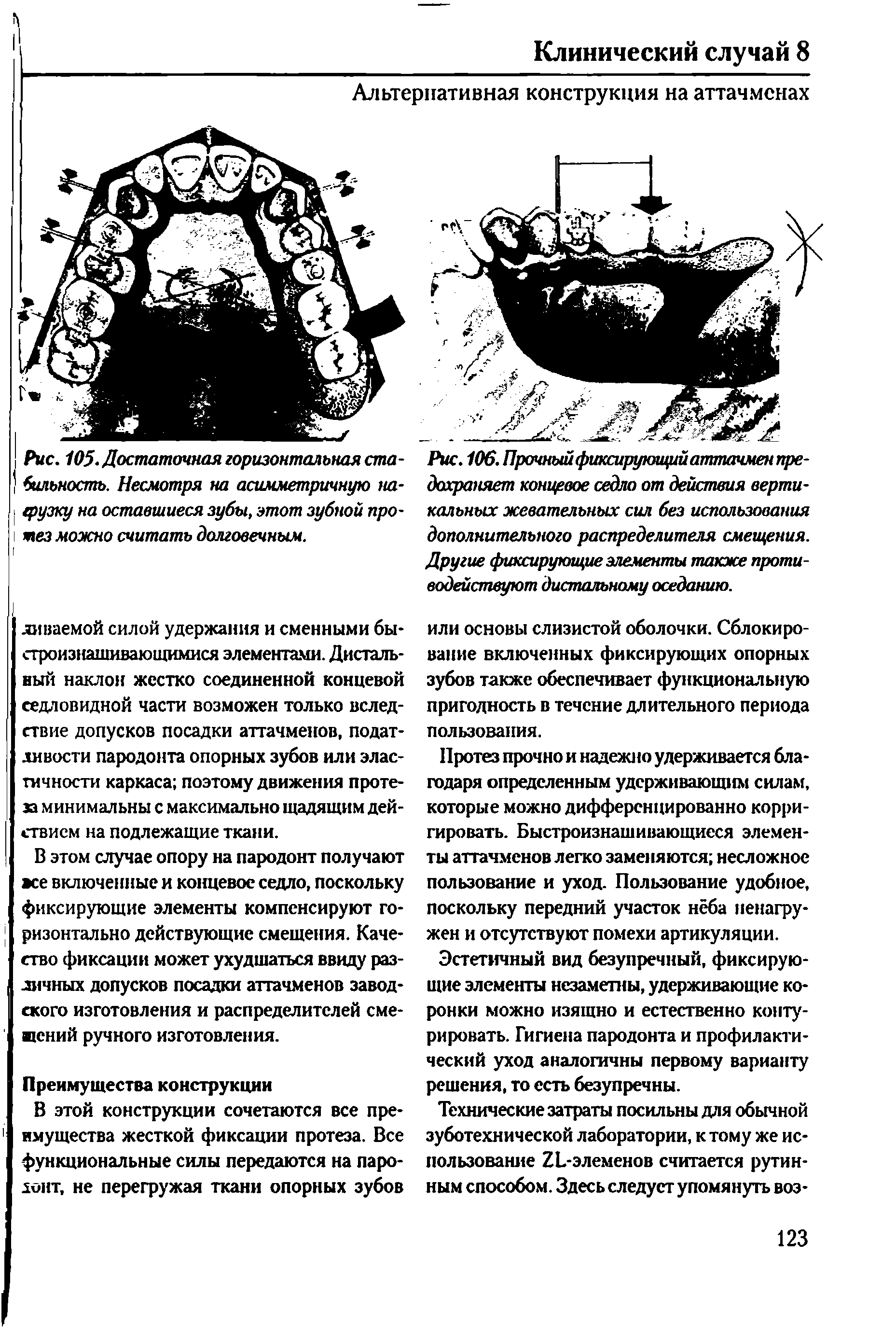 Рис. 105. Достаточная горизонтальная стабильность. Несмотря на асимметричную нагрузку на оставшиеся зубы, этот зубной протез можно считать долговечным.