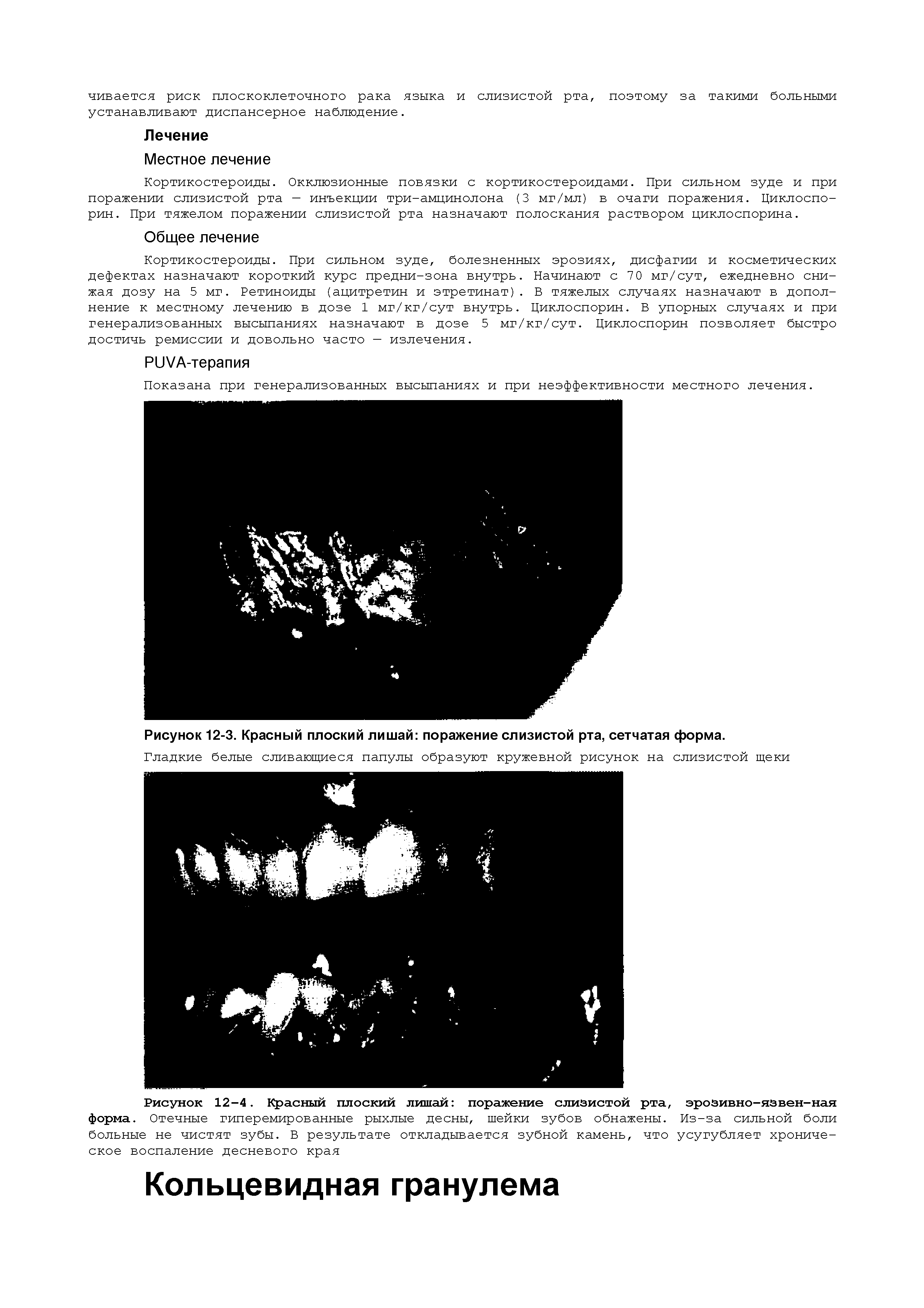 Рисунок 12-3. Красный плоский лишай поражение слизистой рта, сетчатая форма.