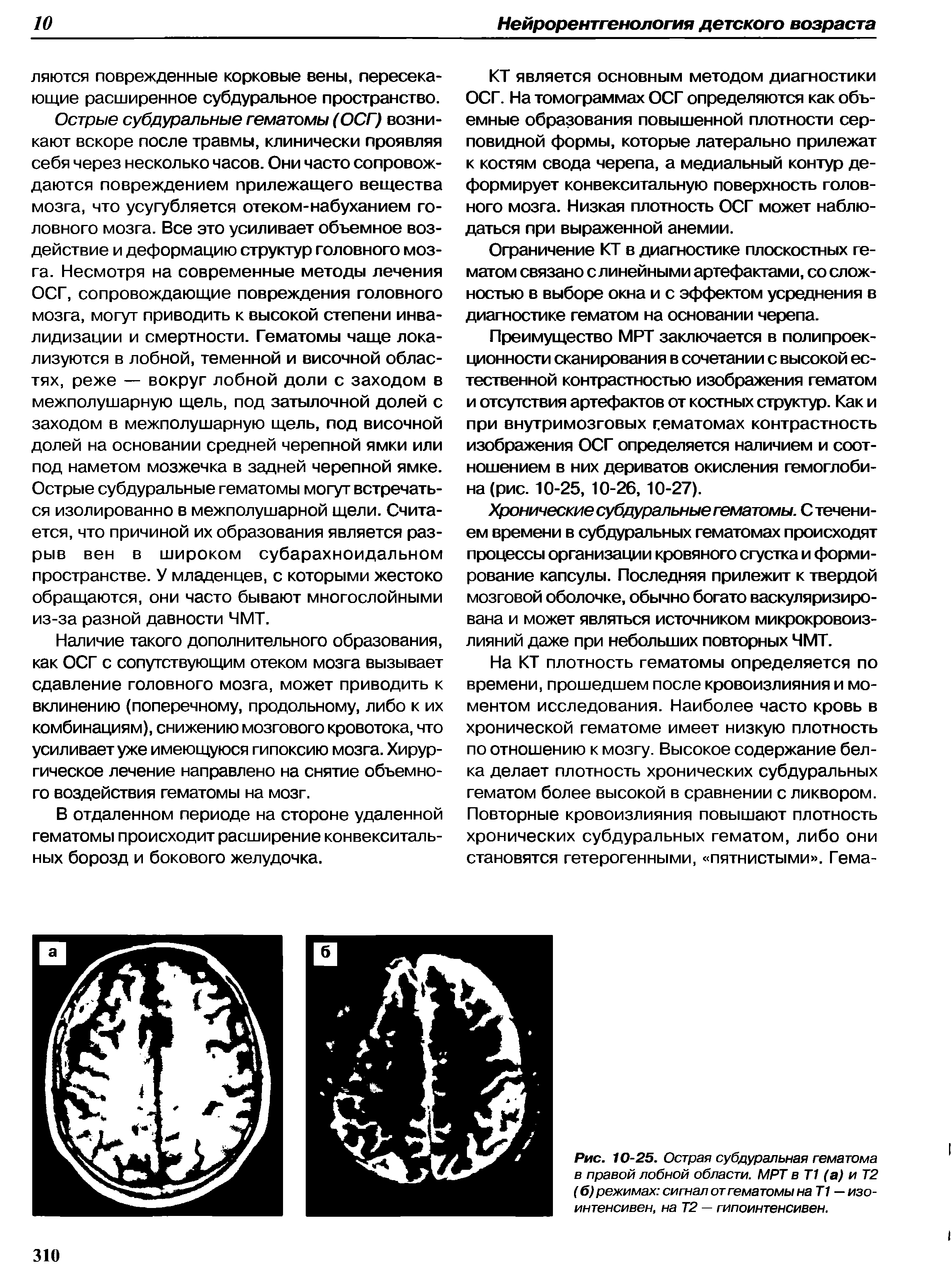 Рис. 10-25. Острая субдуральная гематома в правой лобной области. МРТ в T1 (а) и T2 (б) режимах сигнал от гематомы на T1 —изо-интенсивен, на T2 — гипоинтенсивен.