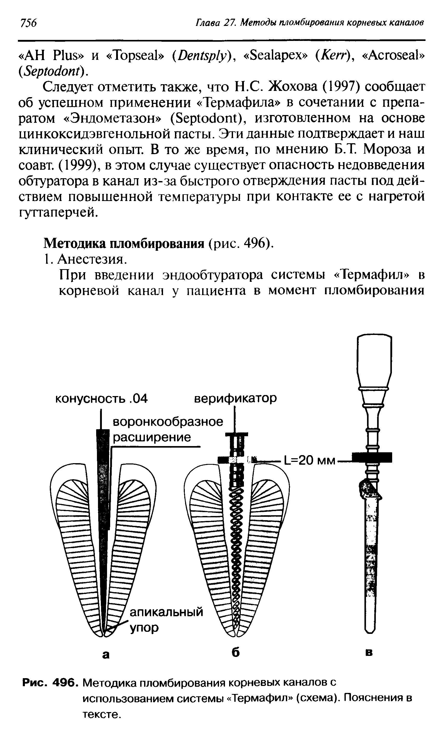 Рис. 496. Методика пломбирования корневых каналов с использованием системы Термафил (схема). Пояснения в тексте.