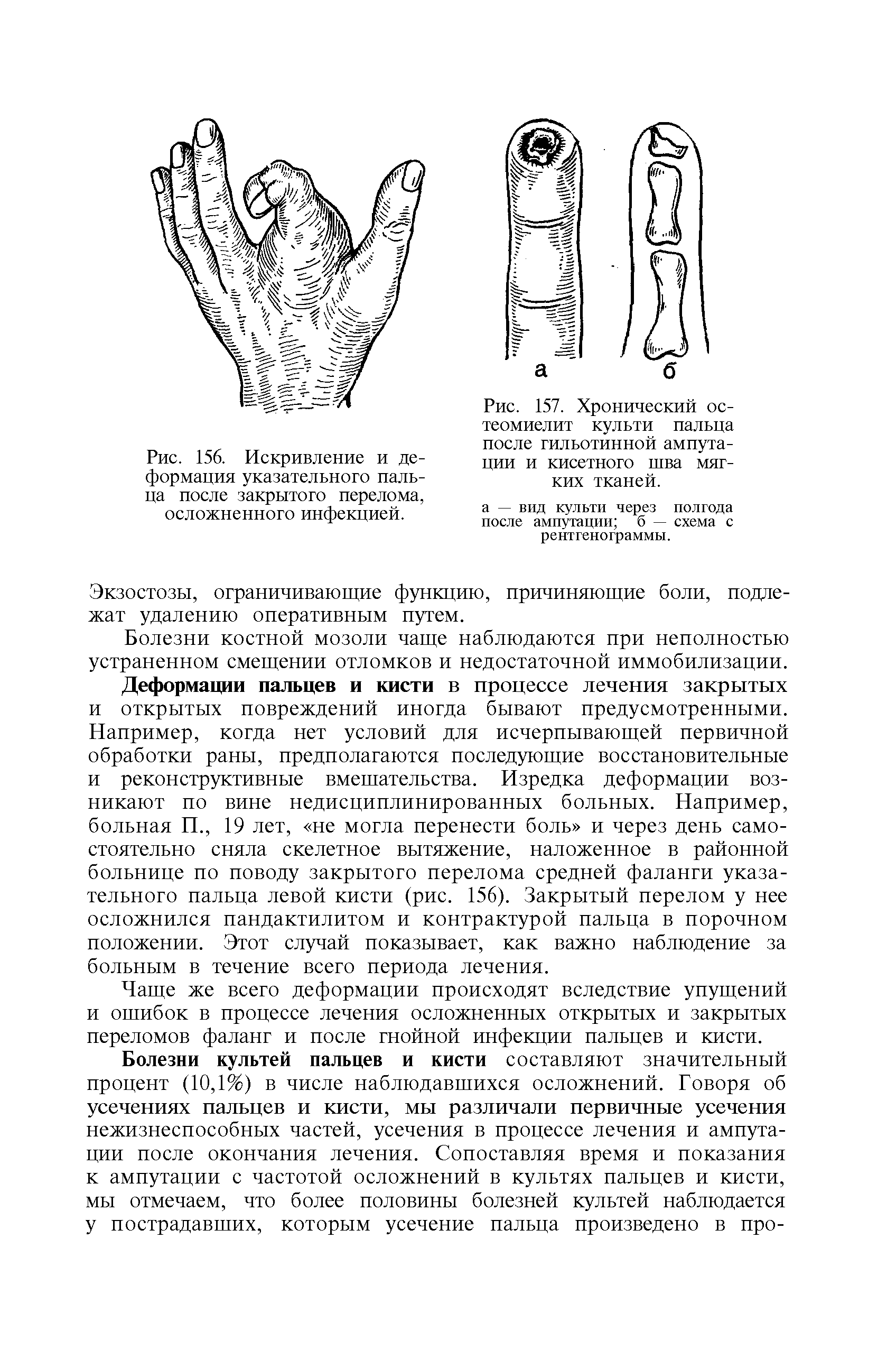 Рис. 157. Хронический остеомиелит культи пальца после гильотинной ампутации и кисетного шва мягких тканей.