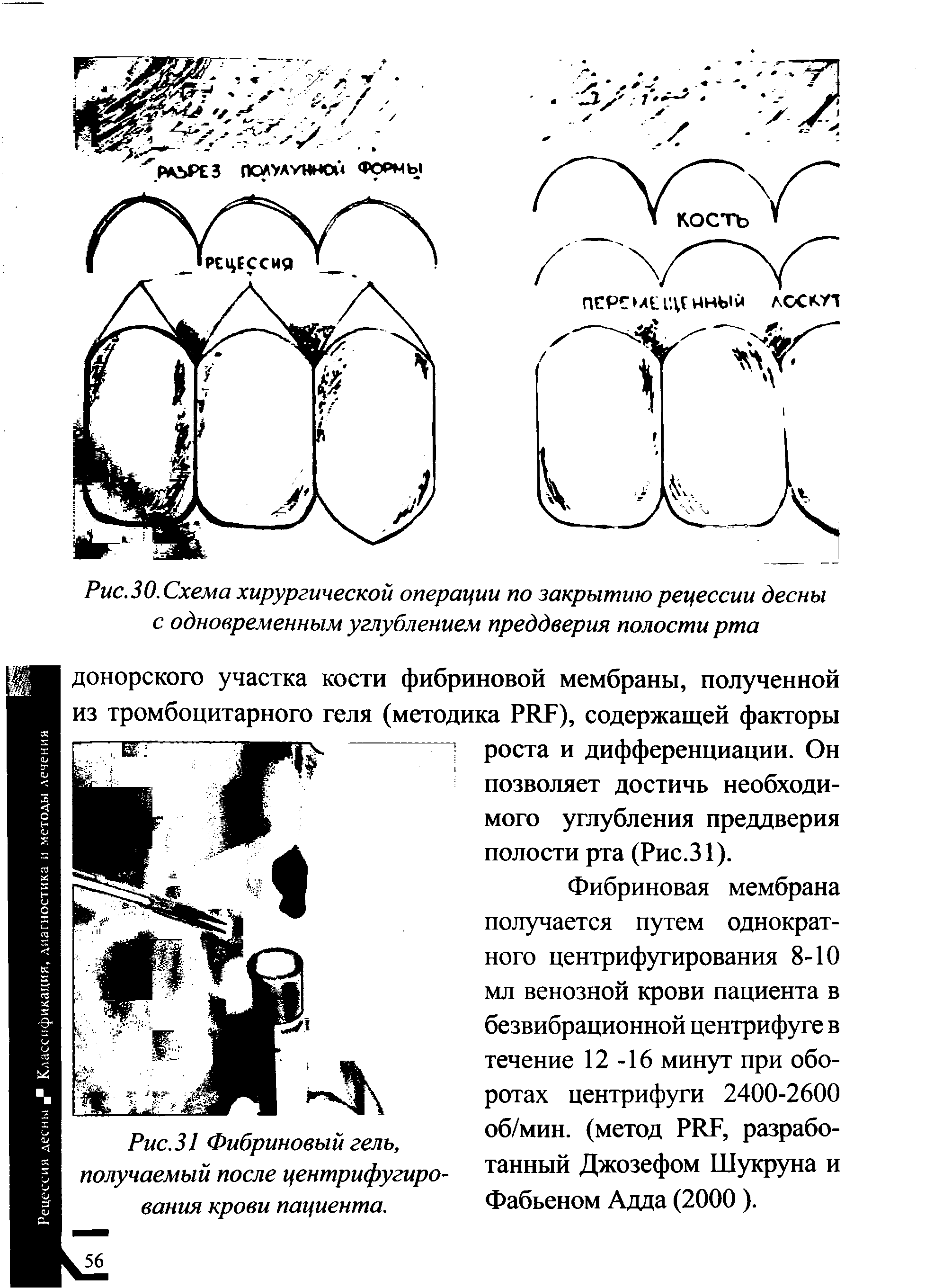 Рис.ЗО.Схема хирургической операции по закрытию рецессии десны с одновременным углублением преддверия полости рта...