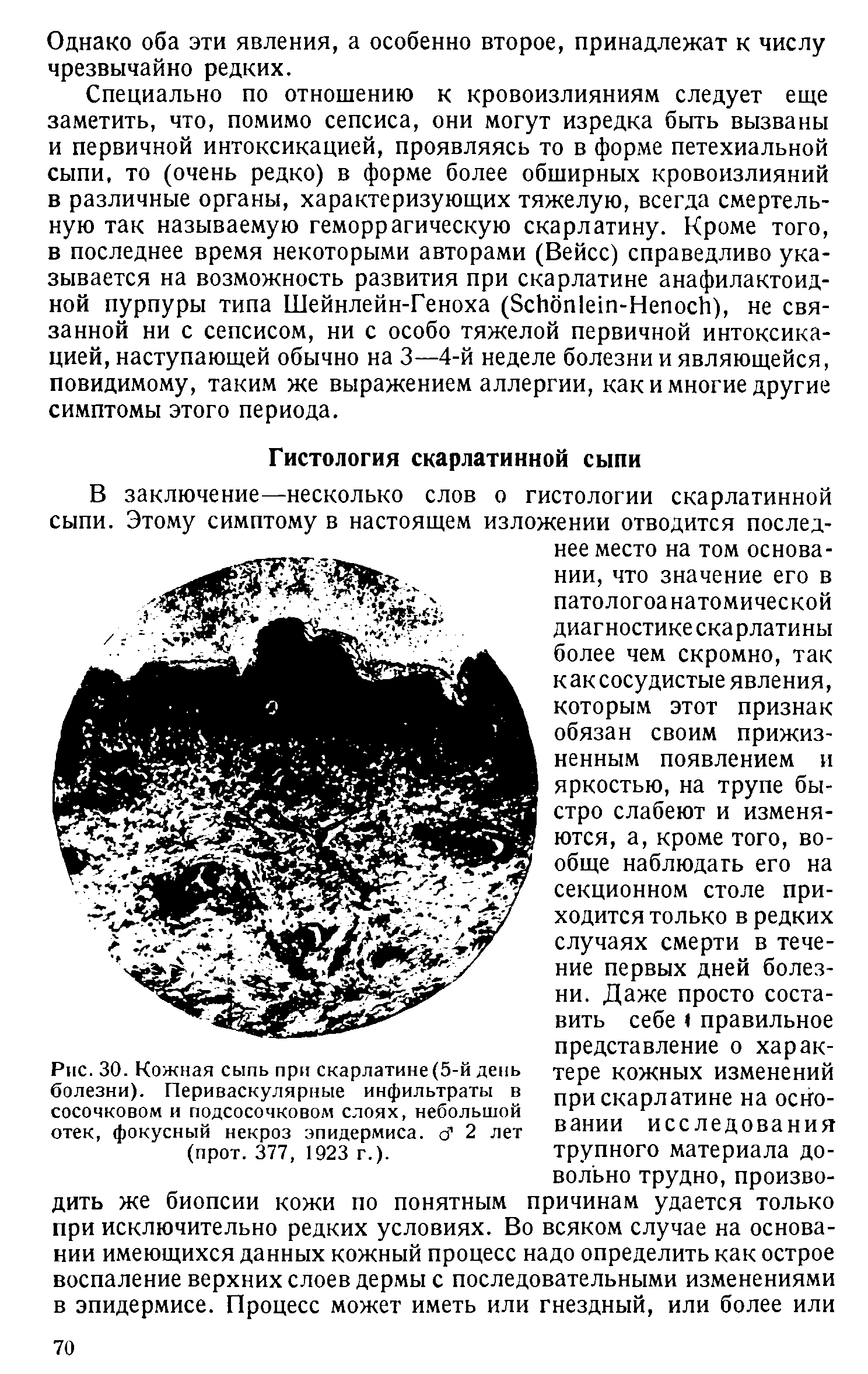 Рис. 30. Кожная сыпь при скарлатине (5-й день болезни). Периваскулярные инфильтраты в сосочковом и подсосочковом слоях, небольшой отек, фокусный некроз эпидермиса. О 2 лет (прот. 377, 1923 г.).