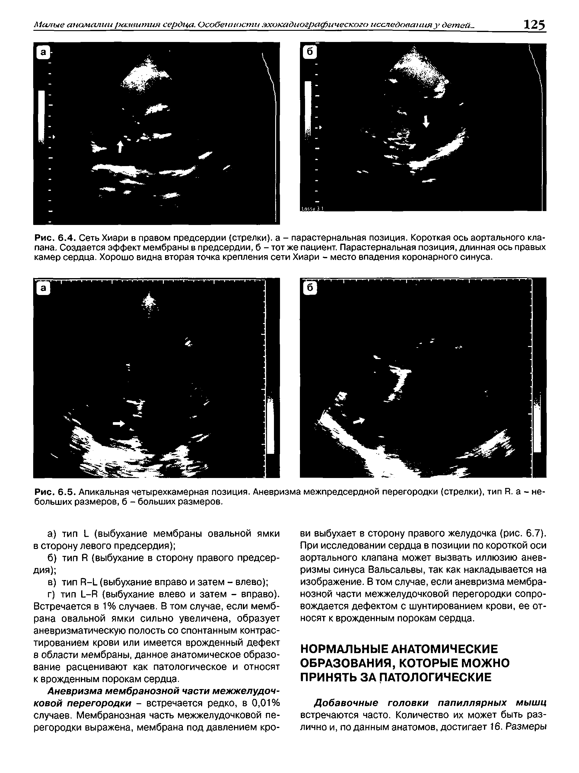 Рис. 6.5. Апикальная четырехкамерная позиция. Аневризма межпредсердной перегородки (стрелки), тип Я. а - не больших размеров, б - больших размеров.