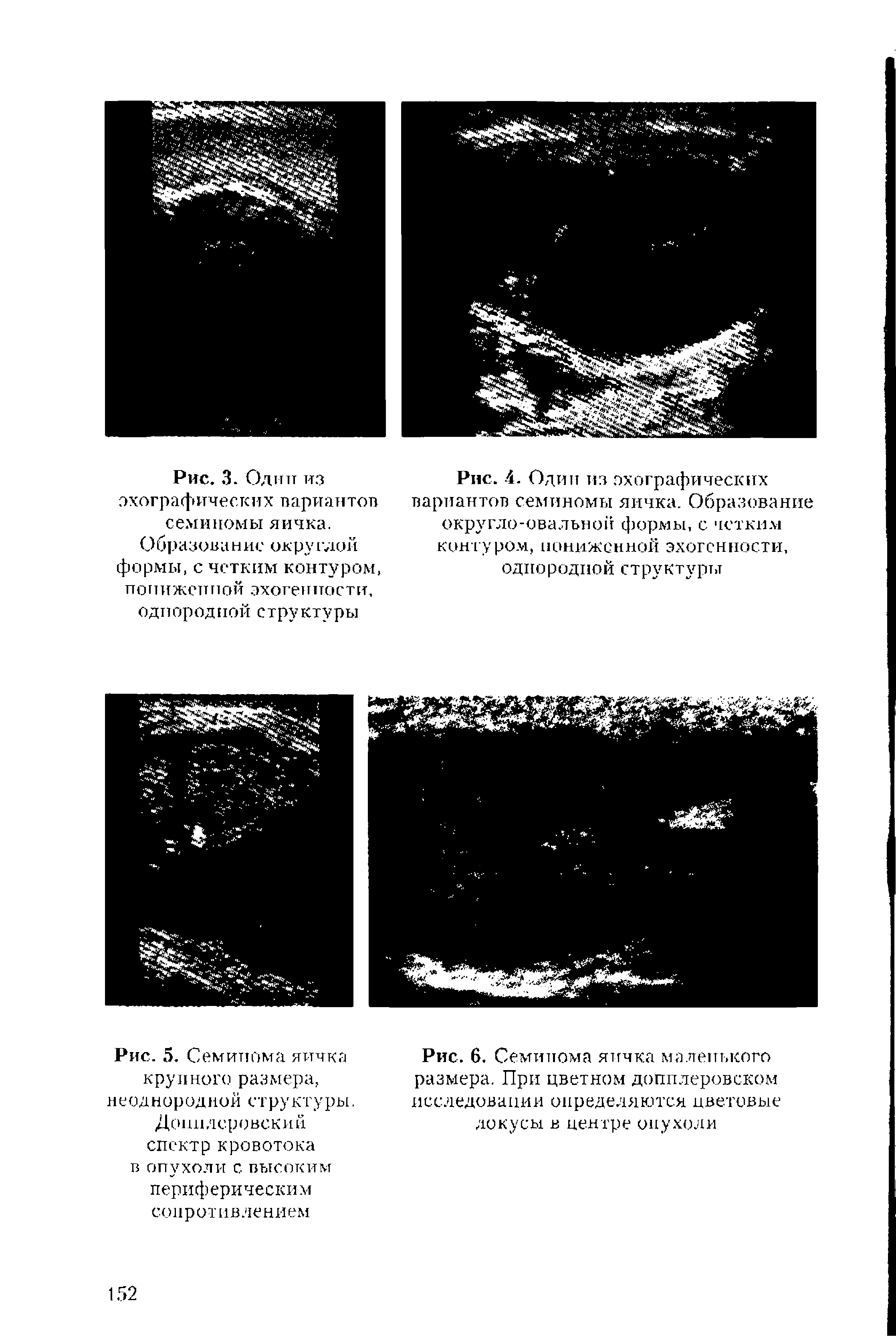 Рис. 4. Один из эхографических вариантов семиномы яичка. Образование округло-овальной формы, с четким контуром, пониженной эхогенности, однородной структуры...