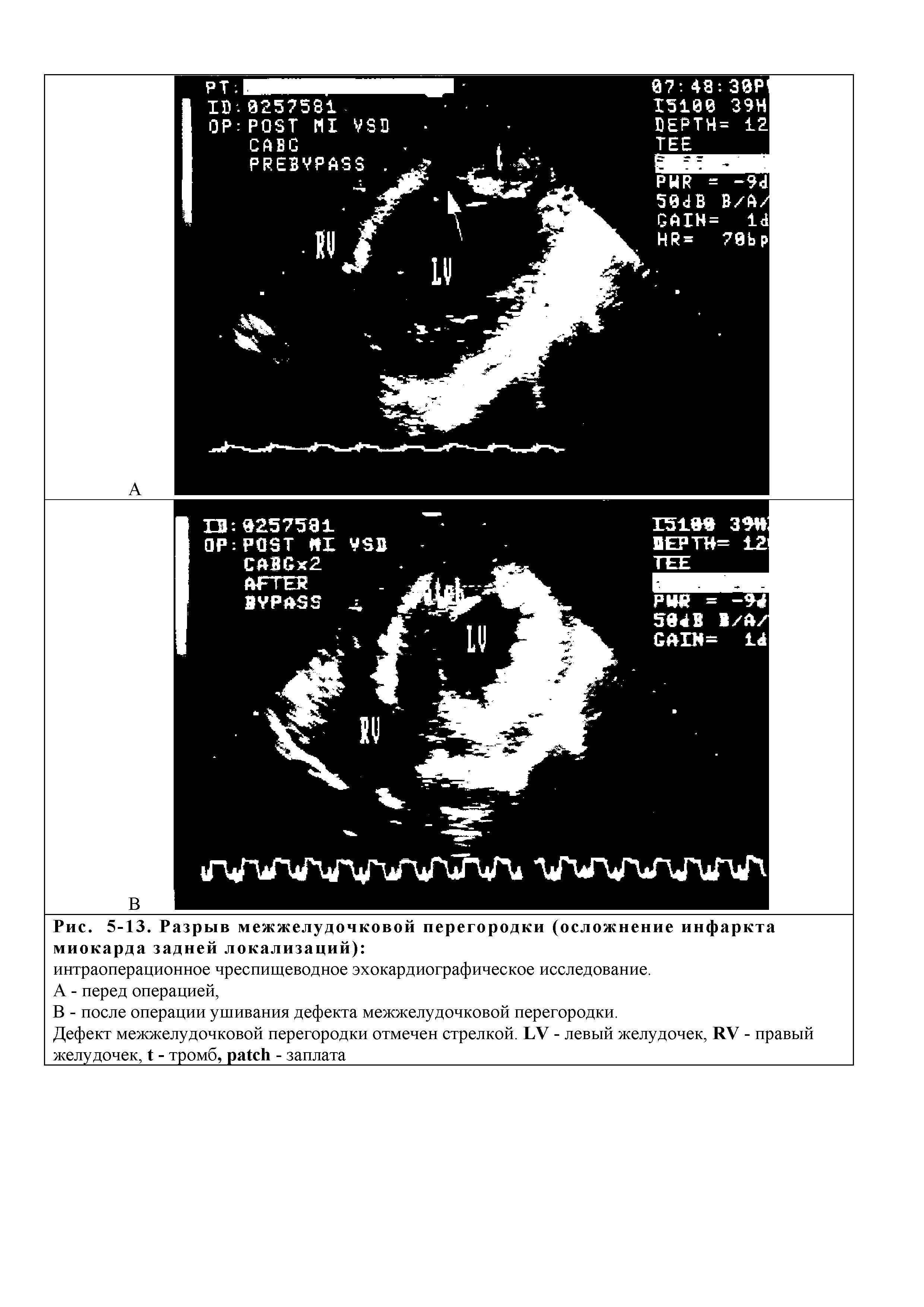 Рис. 5-13. Разрыв межжелудочковой перегородки (осложнение инфаркта миокарда задней локализаций) ...