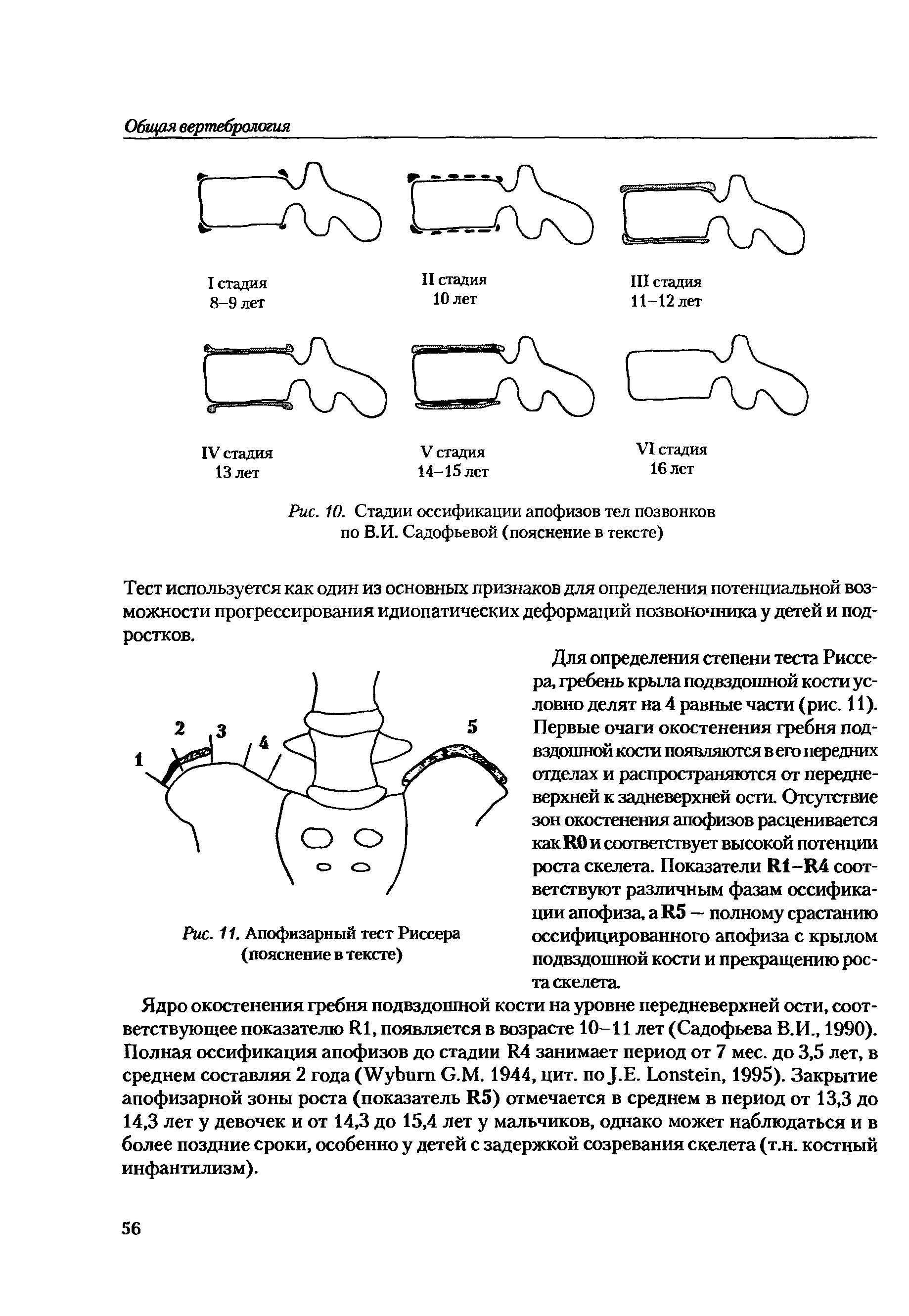 Рис. 10. Стадии оссификации апофизов тел позвонков по В.И. Садофьевой (пояснение в тексте)...