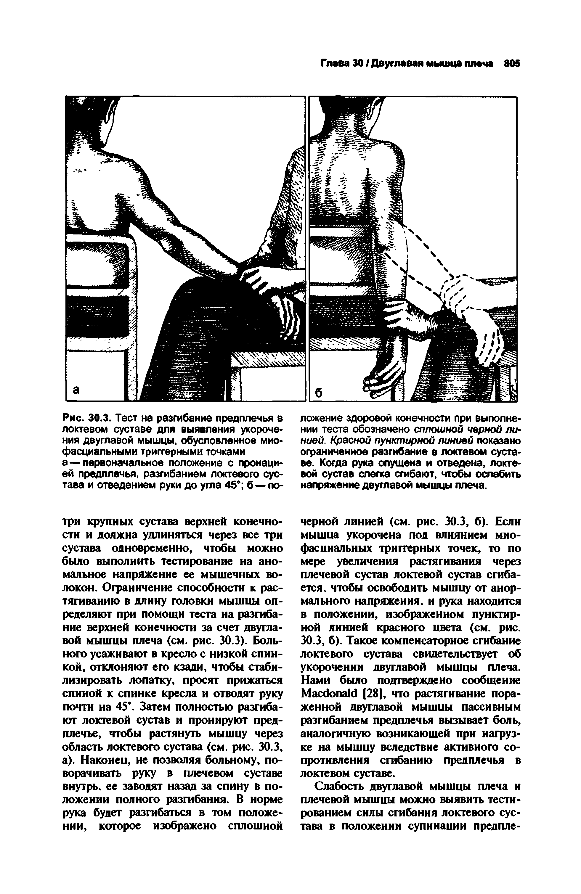 Рис. 30.3. Тест на разгибание предплечья в локтевом суставе для выявления укорочения двуглавой мышцы, обусловленное миофасциальными триггерными точками а—первоначальное положение с пронацией предплечья, разгибанием локтевого сустава и отведением руки до угла 45° б—по-...