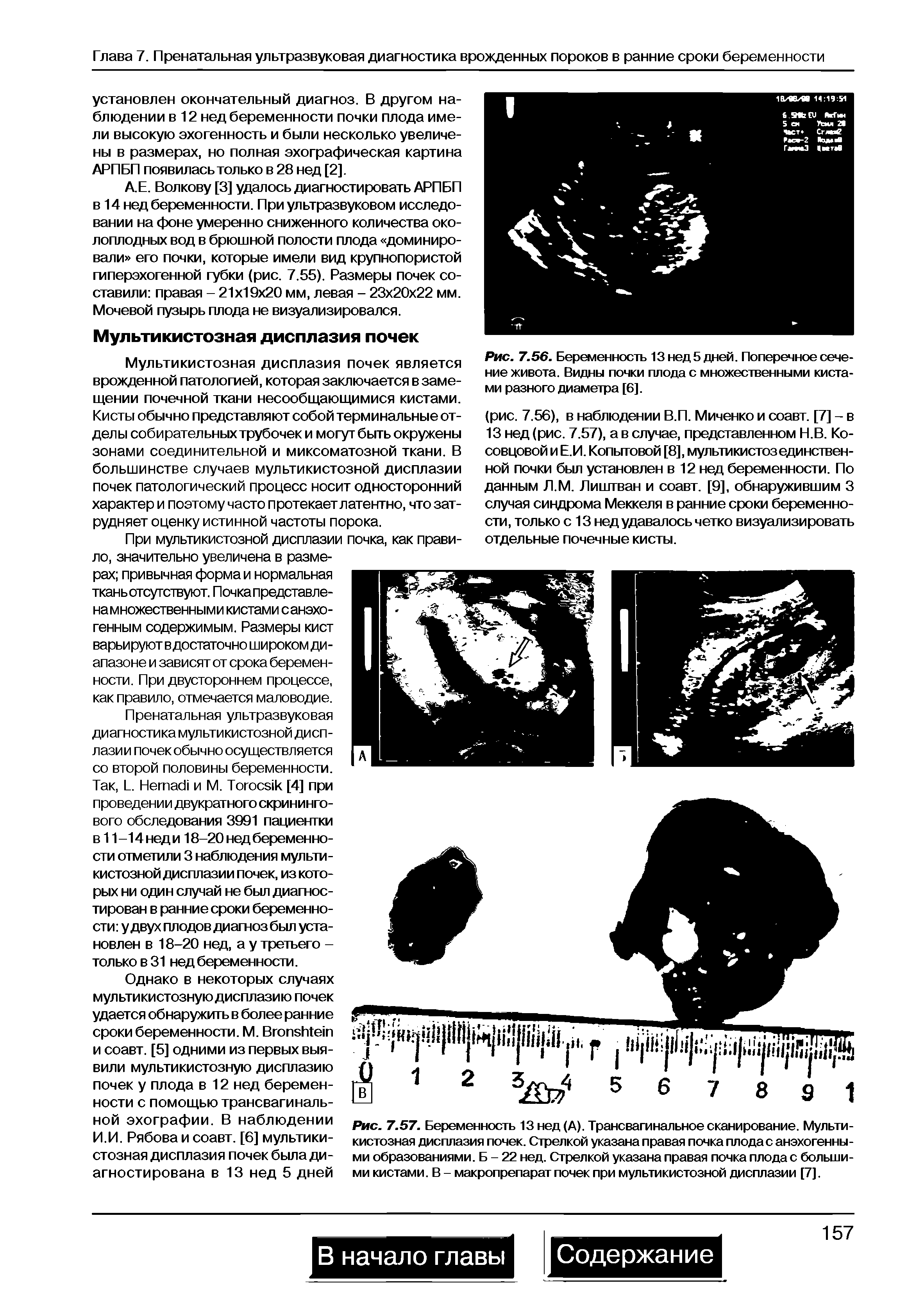 Рис. 7.57. Беременность 13 нед (А). Трансвагинальное сканирование. Мультикистозная дисплазия почек. Стрелкой указана правая почка плодас анэхогенны-ми образованиями. Б - 22 нед. Стрелкой указана правая почка плода с большими кистами. В - макропрепарат почек при мультикистозной дисплазии [7].