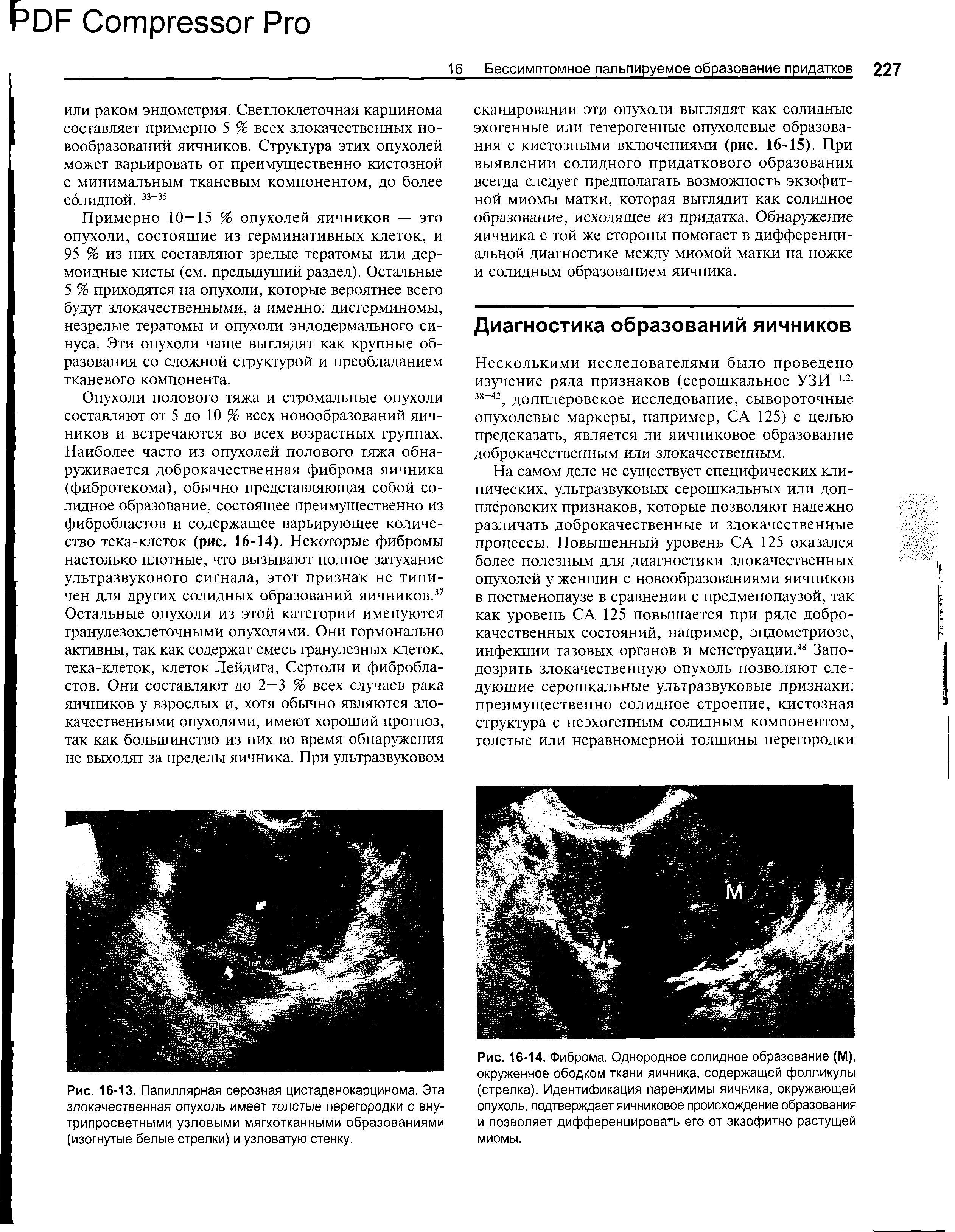 Рис. 16-14. Фиброма. Однородное солидное образование (М), окруженное ободком ткани яичника, содержащей фолликулы (стрелка). Идентификация паренхимы яичника, окружающей опухоль, подтверждает яичниковое происхождение образования и позволяет дифференцировать его от экзофитно растущей...