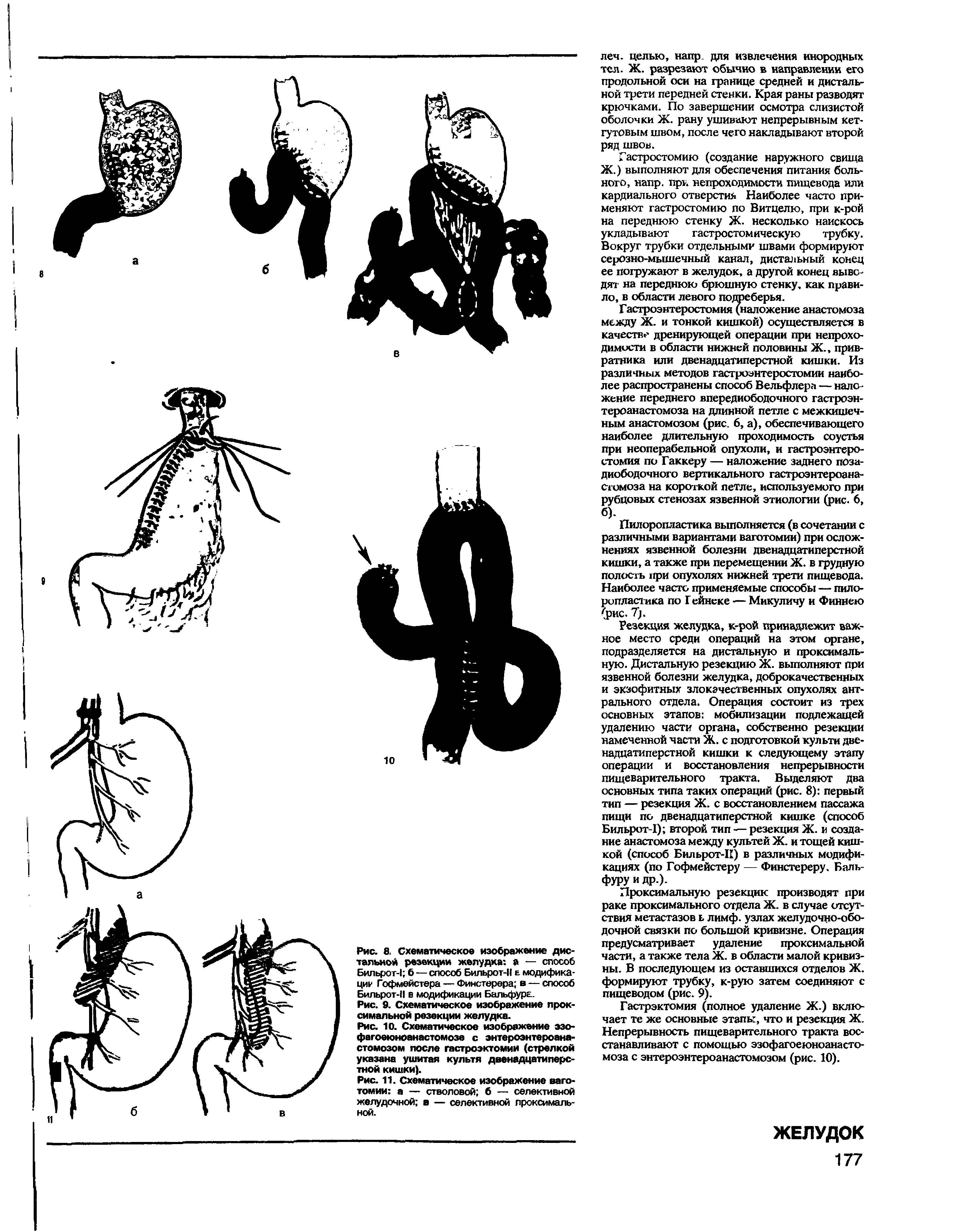 Рис. 10. Схематическое изображение эзо-фагоеюноанастомозе с энтероэнтероанастомозом после гастроэктомии (стрелкой указана ушитая культя двенадцатиперстной кишки).