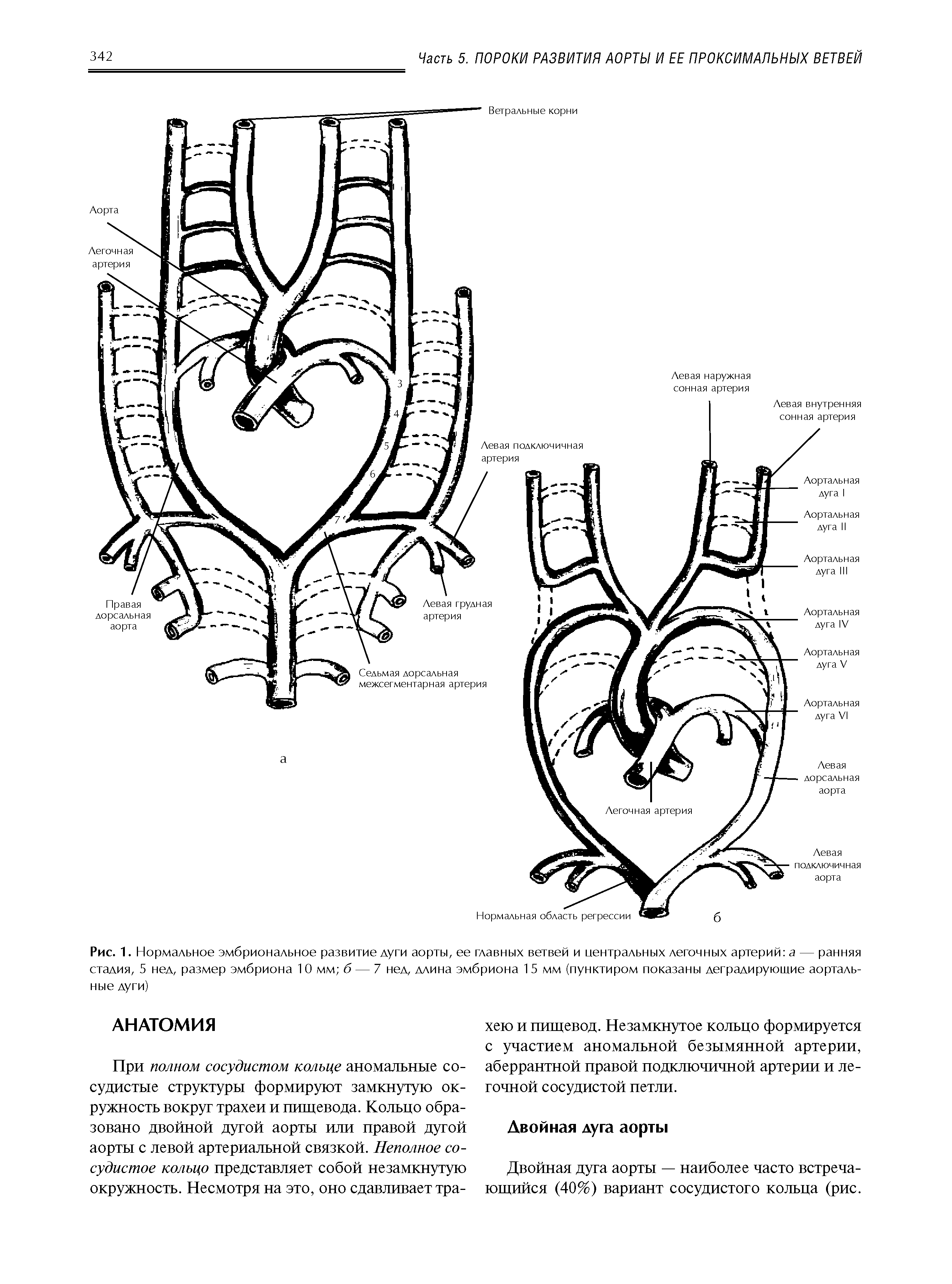 Рис. 1. Нормальное эмбриональное развитие дуги аорты, ее главных ветвей и нейтральных легочных артерий а — ранняя стадия, 5 нед, размер эмбриона 1 0 мм б — 7 нед, длина эмбриона 1 5 мм (пунктиром показаны деградирующие аортальные дуги)...