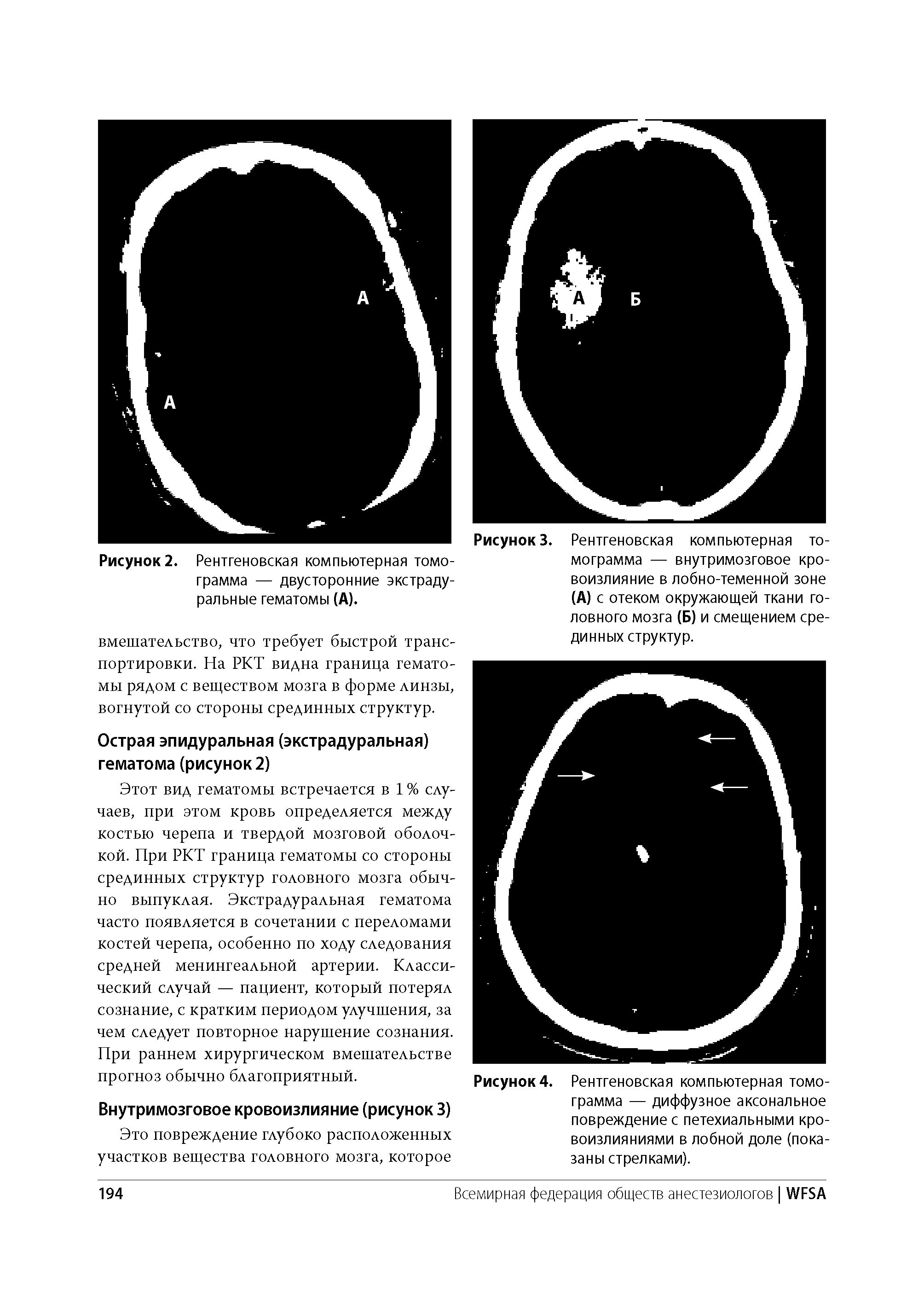 Рисунок 2. Рентгеновская компьютерная томограмма — двусторонние экстрадуральные гематомы (А).