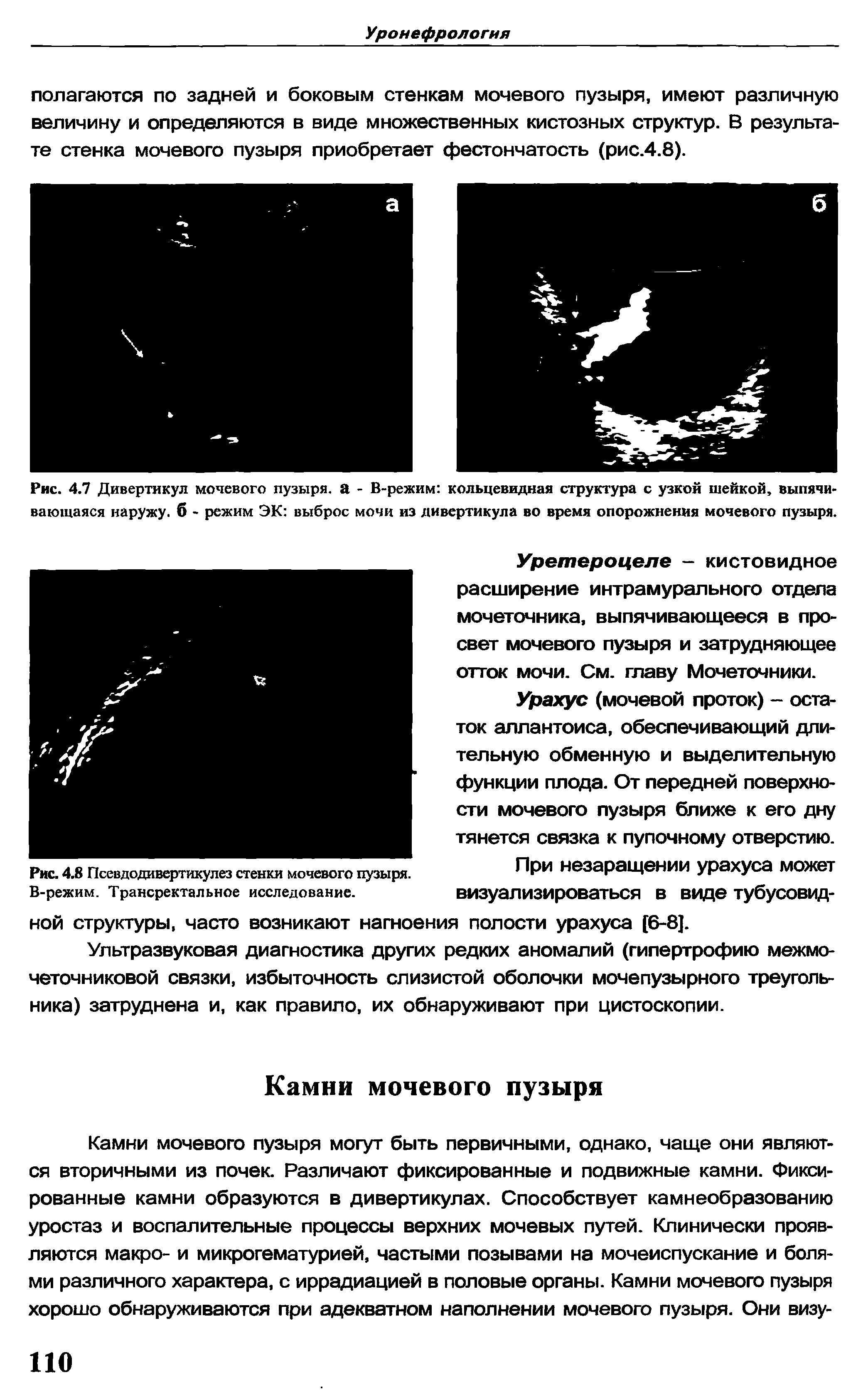 Рис. 4.7 Дивертикул мочевого пузыря, а - В-режим кольцевидная структура с узкой шейкой, выпячивающаяся наружу, б - режим ЭК выброс мочи из дивертикула во время опорожнения мочевого пузыря.