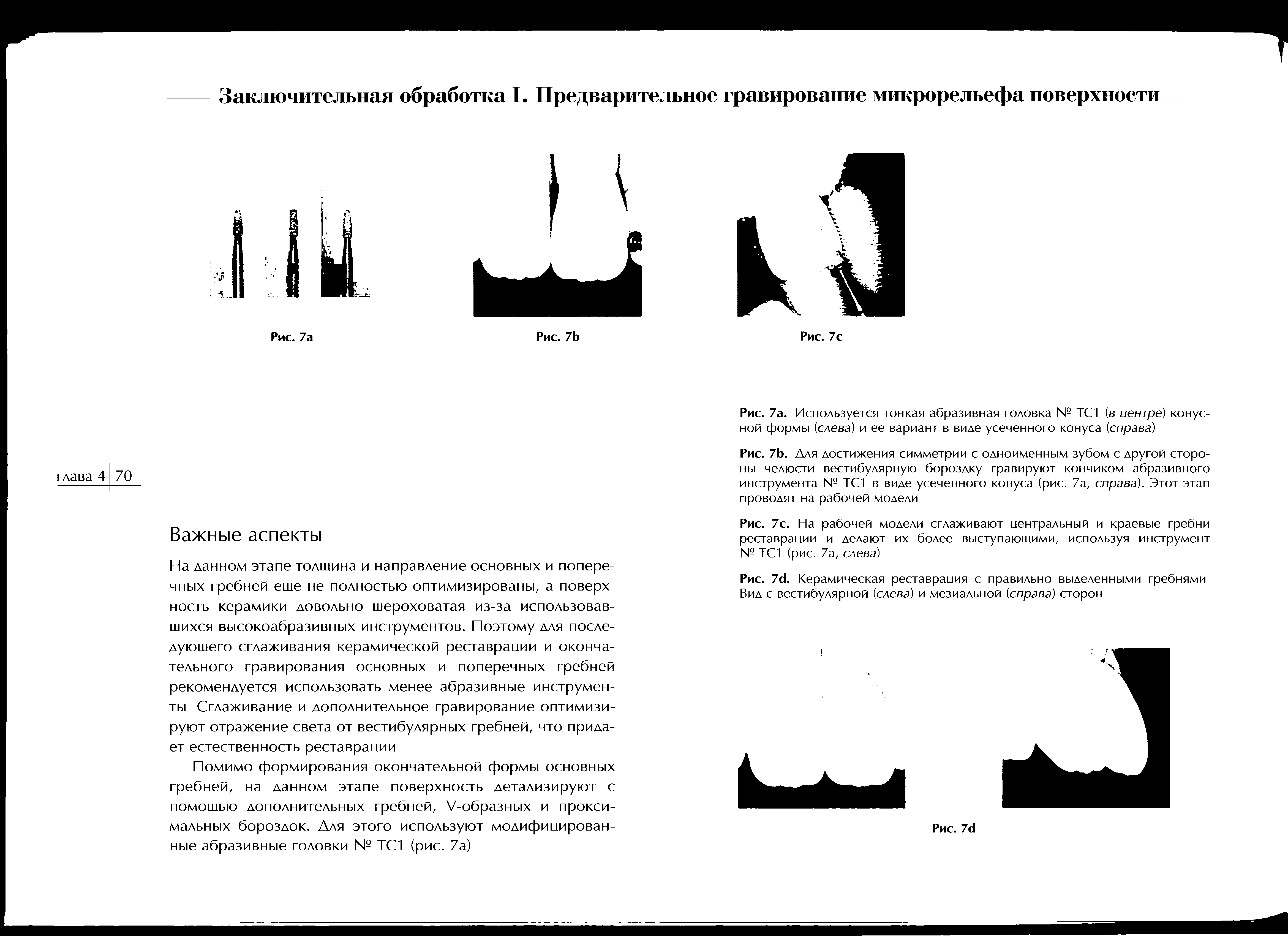 Рис. 7Ь. Для достижения симметрии с одноименным зубом с другой стороны челюсти вестибулярную бороздку гравируют кончиком абразивного инструмента № ТС1 в виде усеченного конуса (рис. 7а, справа). Этот этап проводят на рабочей модели...