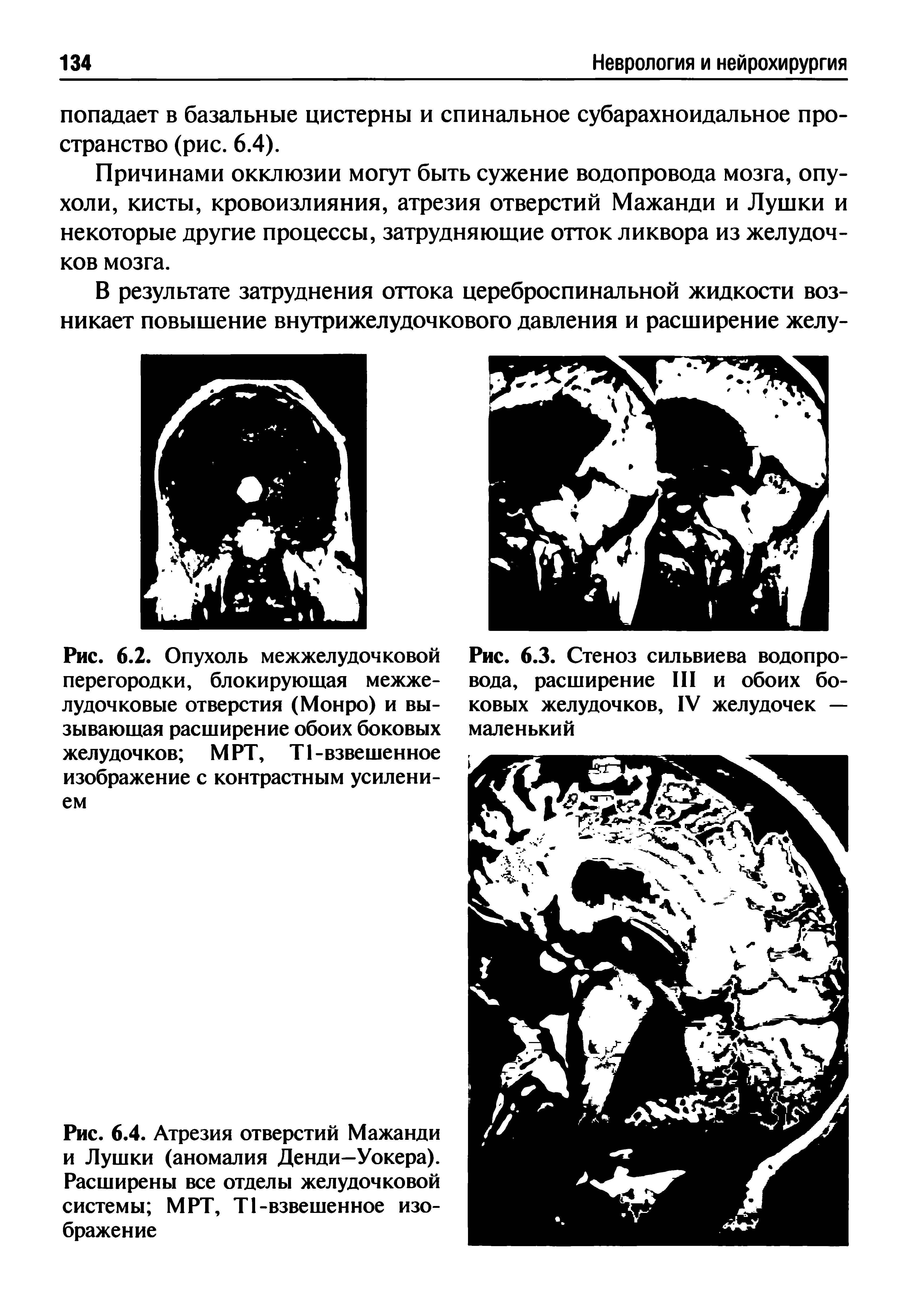 Рис. 6.4. Атрезия отверстий Мажанди и Лушки (аномалия Денди—Уокера). Расширены все отделы желудочковой системы МРТ, Т1-взвешенное изображение...