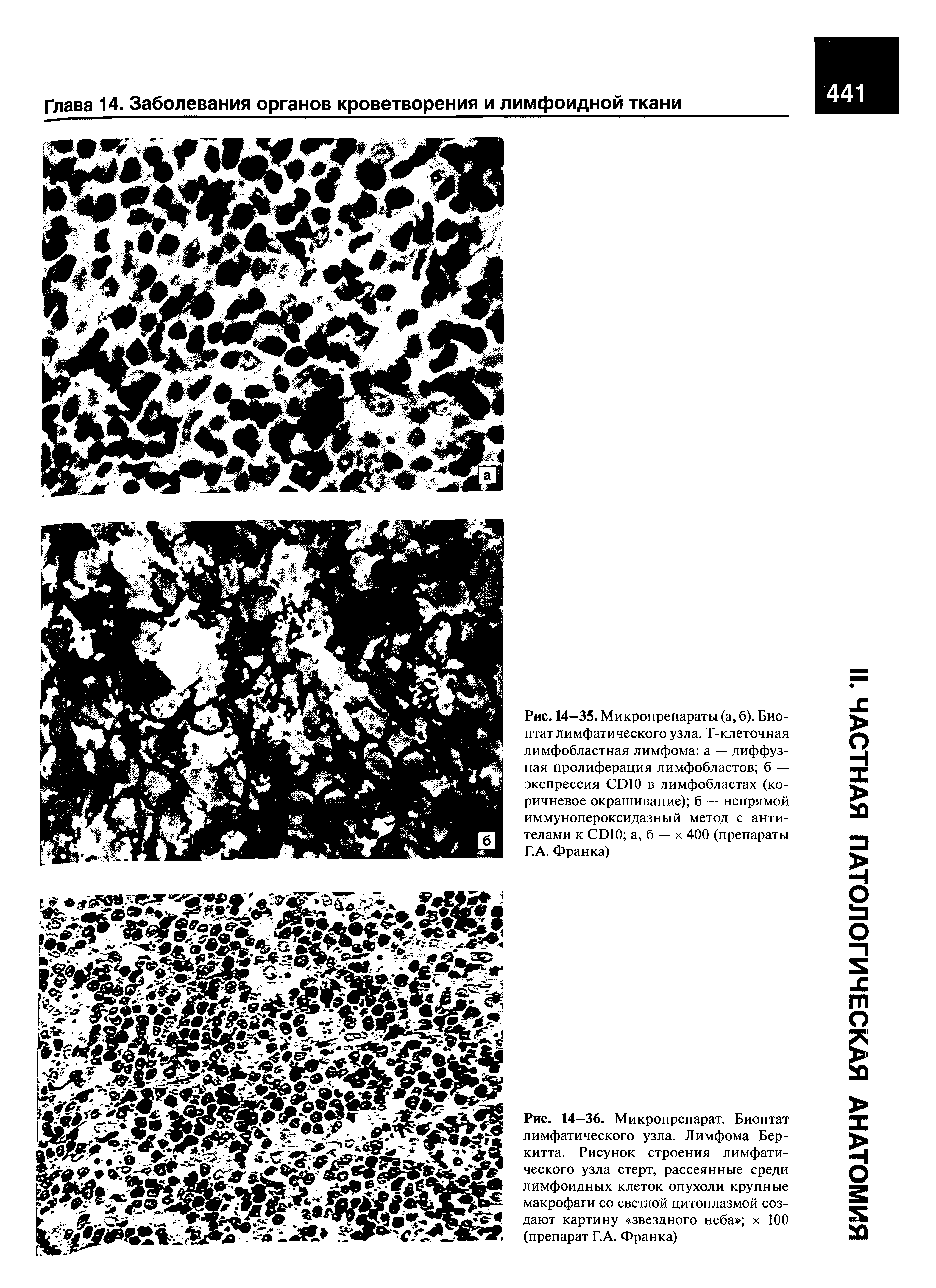 Рис. 14—35. Микропрепараты (а, б). Био-птат лимфатического узла. Т-клеточная лимфобластная лимфома а — диффузная пролиферация лимфобластов б — экспрессия СЭЮ в лимфобластах (коричневое окрашивание) б — непрямой иммунопероксидазный метод с антителами к СЭЮ а, б — х 400 (препараты Г.А. Франка)...
