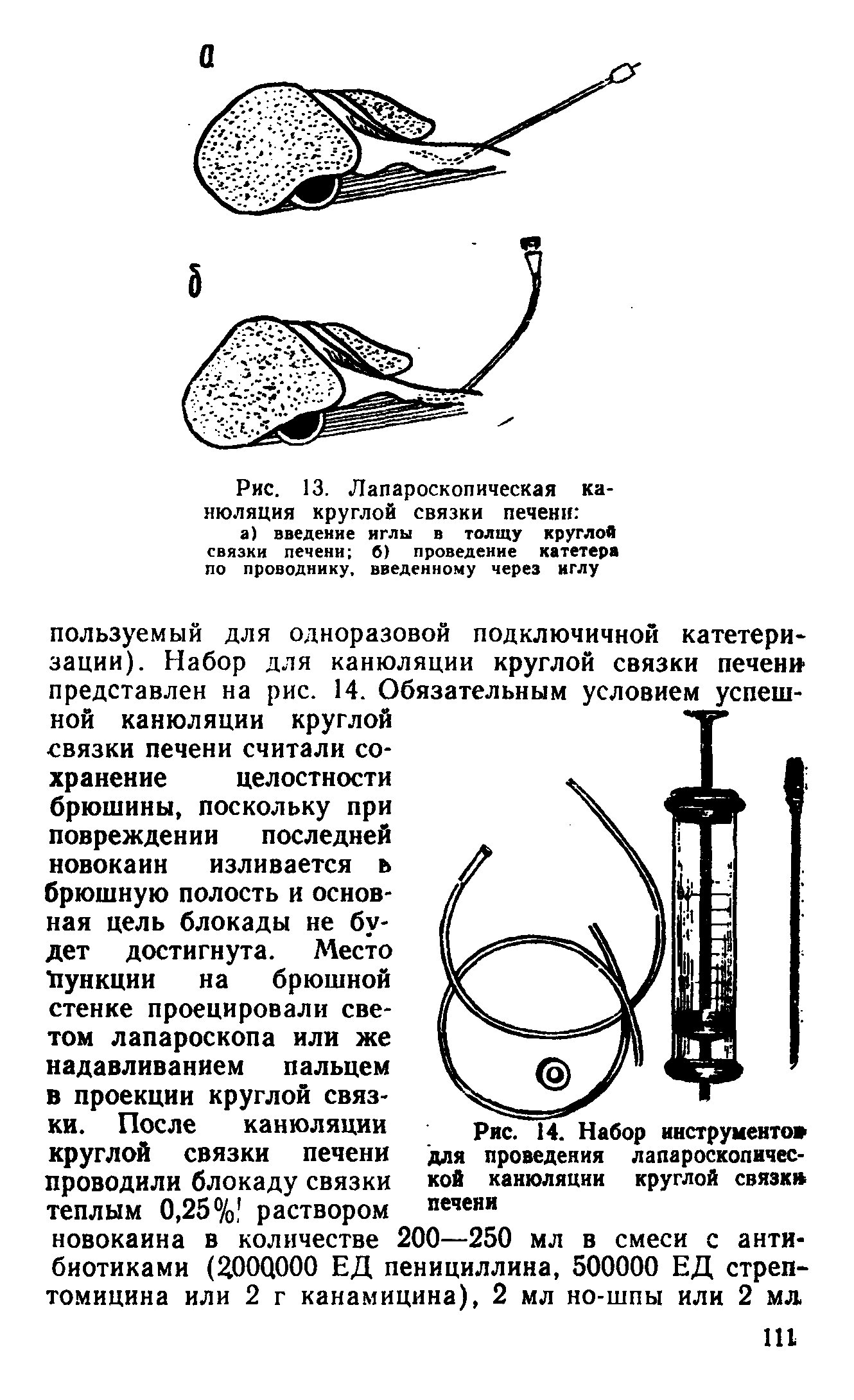 Рис. 13. Лапароскопическая канюляция круглой связки печени а) введение иглы в толщу круглой связки печени б) проведение катетера по проводнику, введенному через иглу...