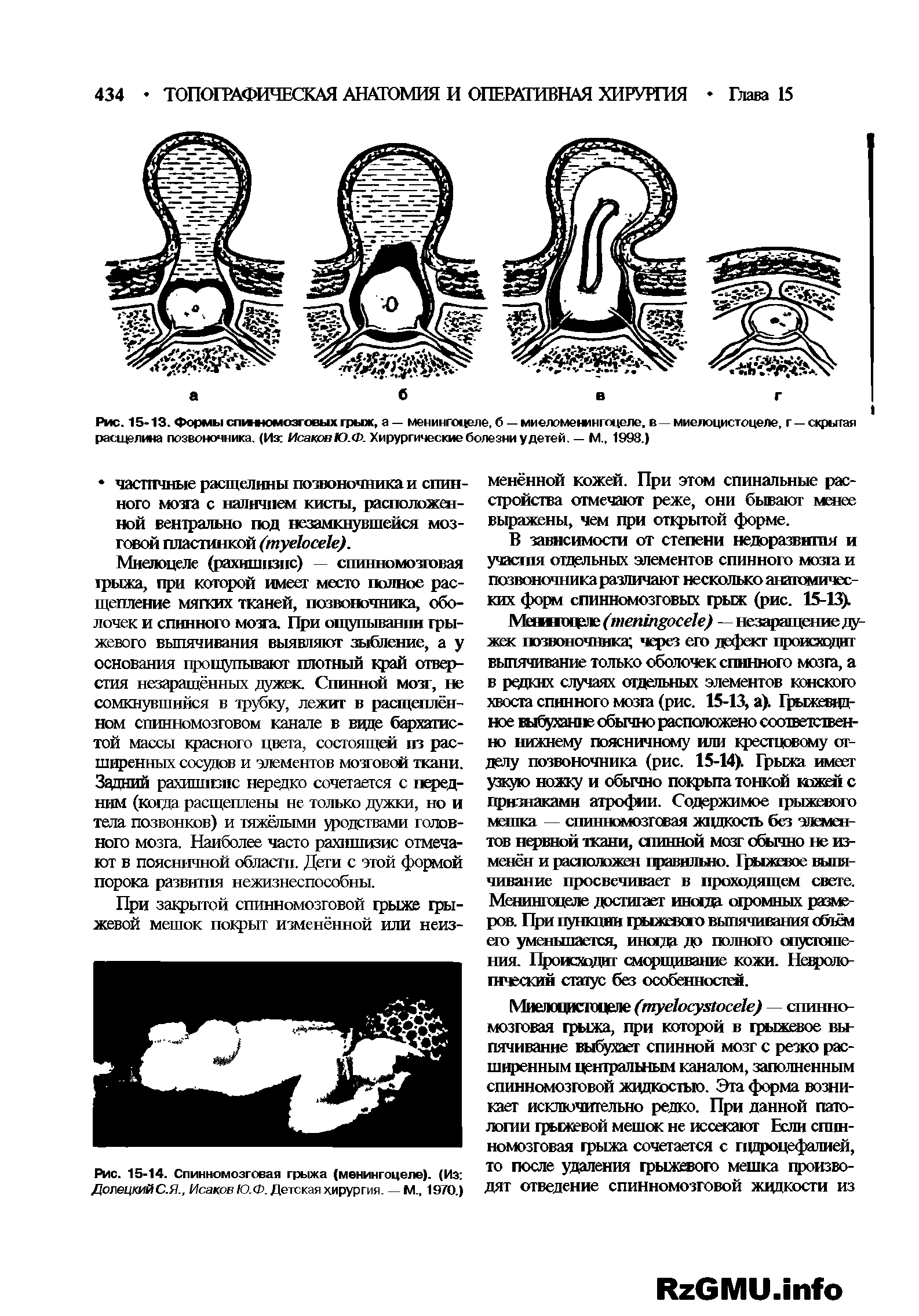 Рис. 15-13. Формы спинномозговых грыж, а — менингоцеле, б — миеломенингоцеле, в—миелоцистоцеле, г —скрытая расц лина позвоночника. (Из Исаков Ю.Ф. Хирургические болезни у детей. — М., 1998.)...