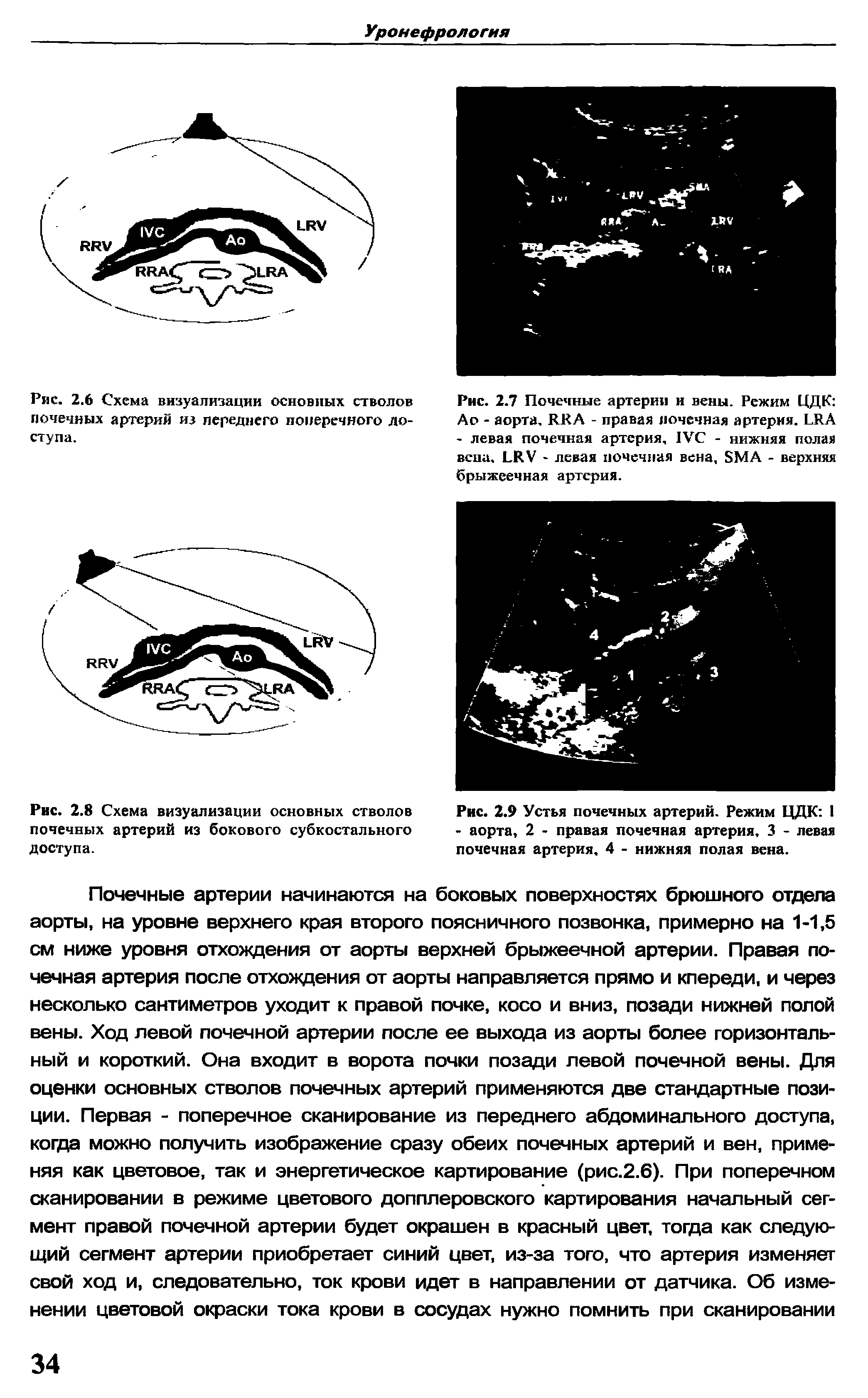 Рис. 2.7 Почечные артерии и вены. Режим ЦЦК Ао - аорта, RRA - правая почечная артерия. LRA - левая почечная артерия, IVC - нижняя полая вена. LRV - левая почечная вена, SMA - верхняя брыжеечная артерия.