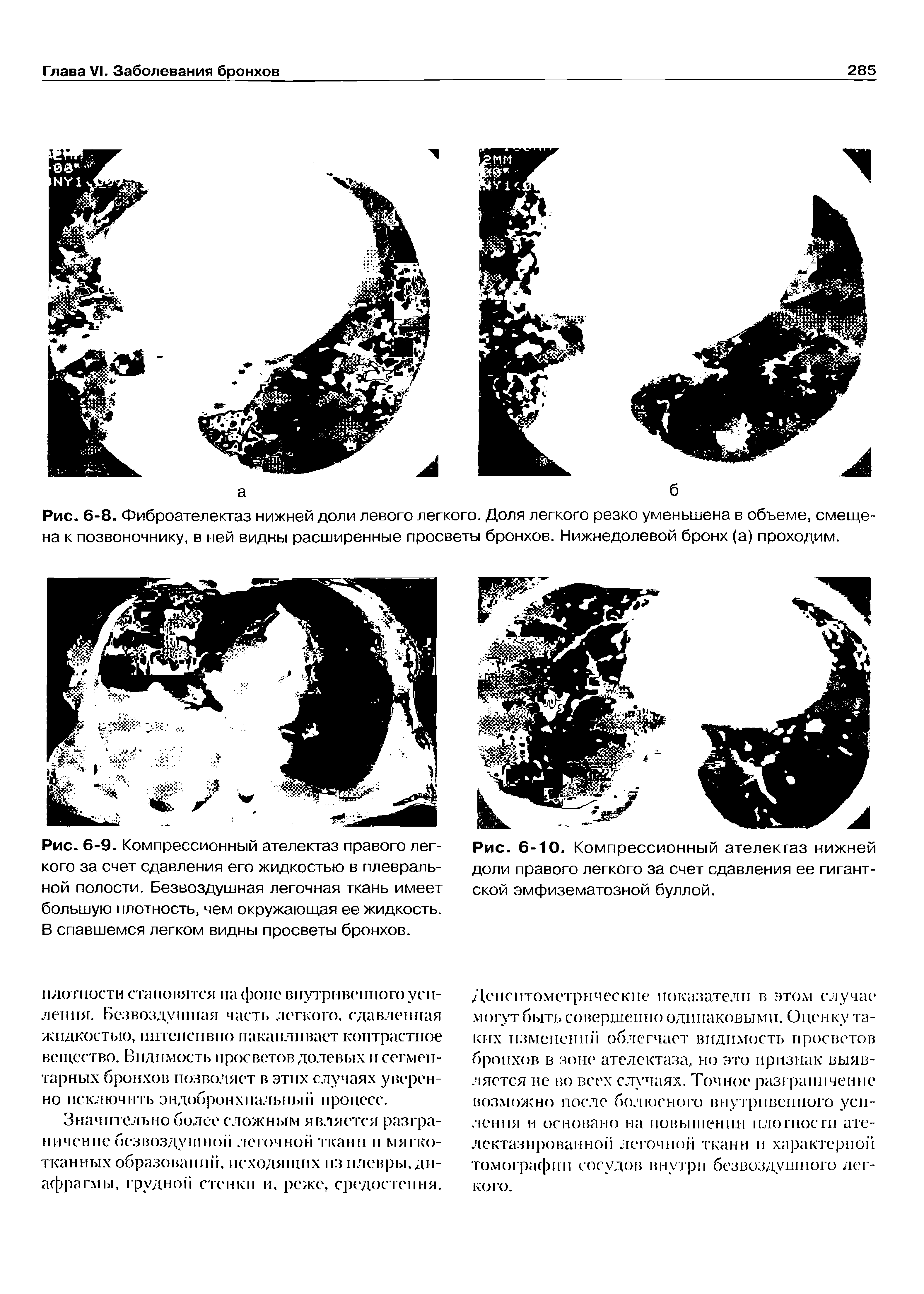 Рис. 6-8. Фиброателектаз нижней доли левого легкого. Доля легкого резко уменьшена в объеме, смещена к позвоночнику, в ней видны расширенные просветы бронхов. Нижнедолевой бронх (а) проходим.