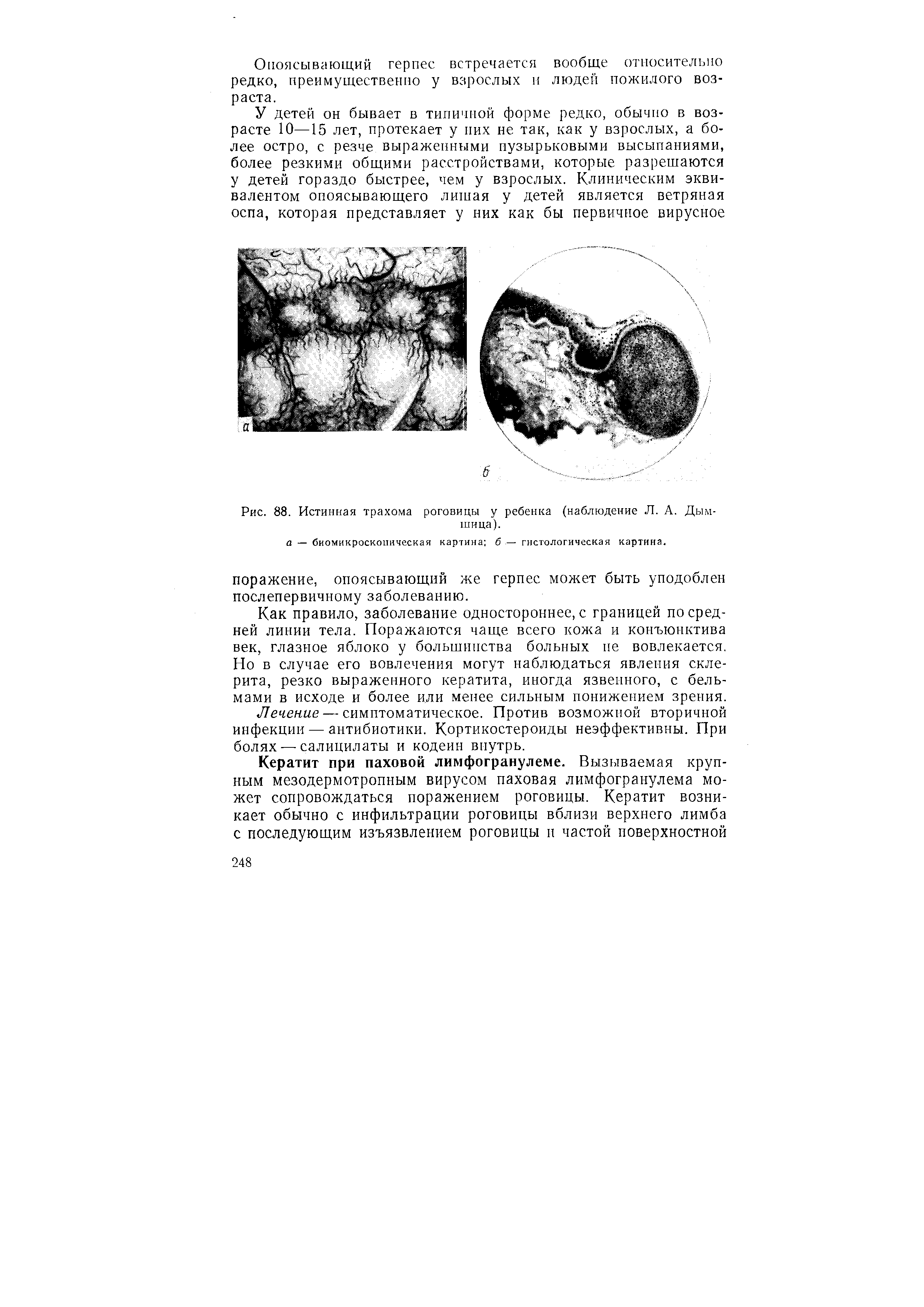 Рис. 88. Истинная трахома роговицы у ребенка (наблюдение Л. А. Дым-шица).