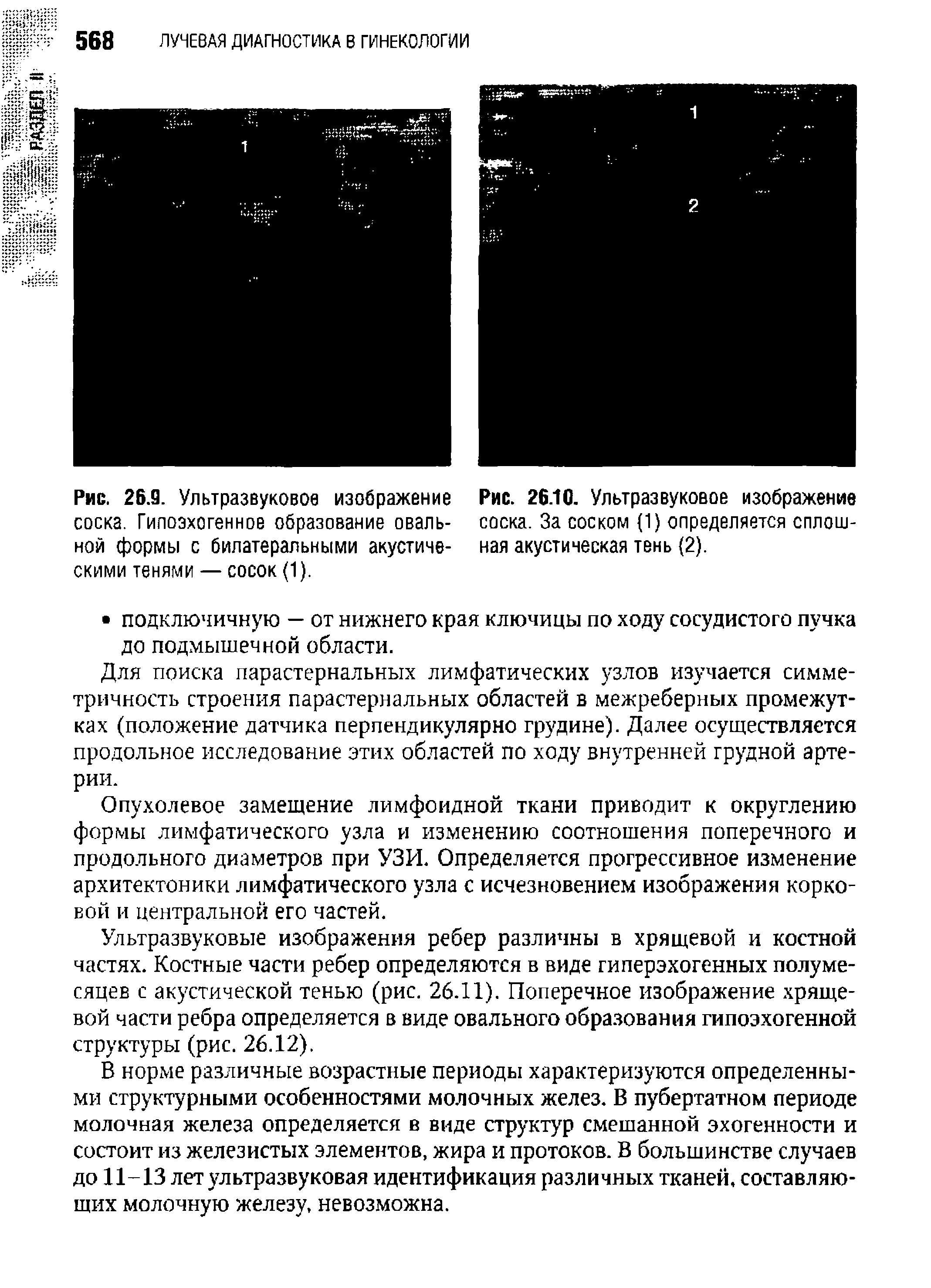 Рис. 26.10. Ультразвуковое изображение соска. За соском (1) определяется сплошная акустическая тень (2).