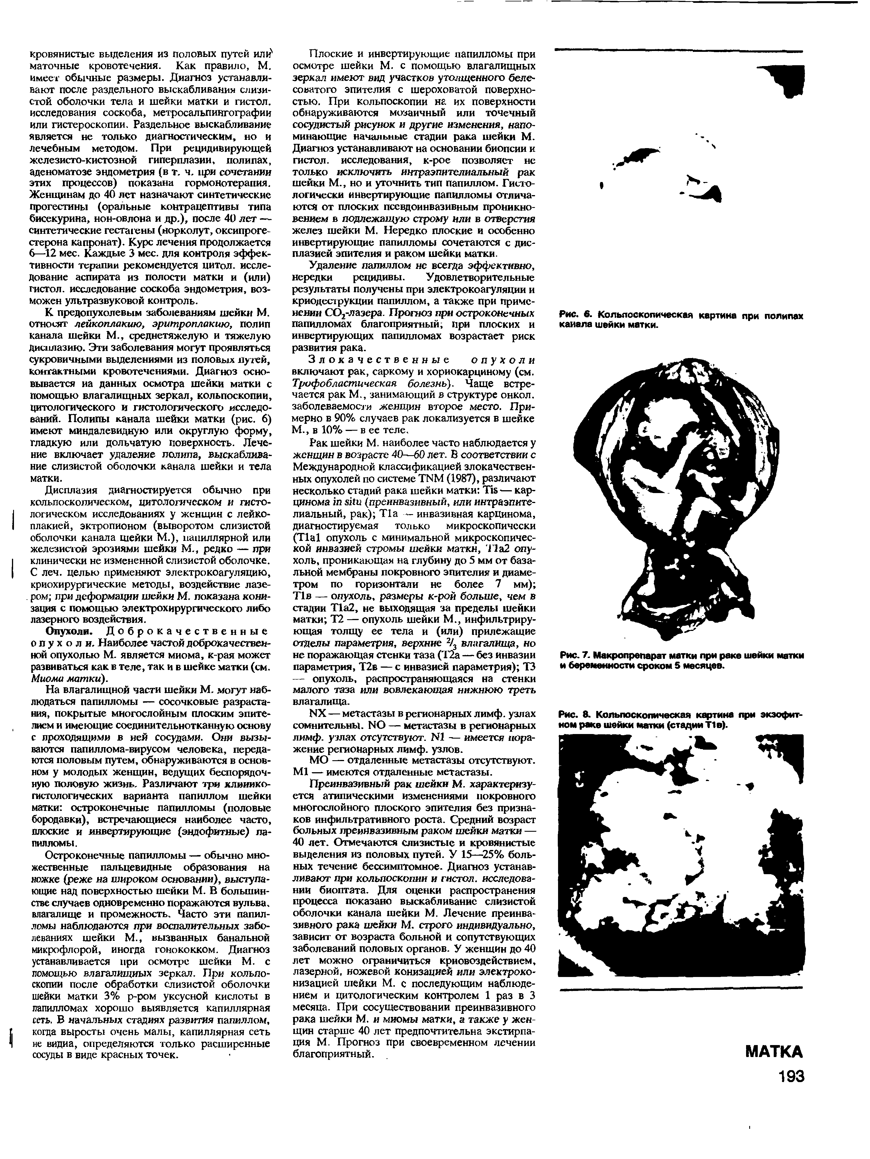 Рис. 7. Макропрепарат матки при раке шейки матки и беременности сроком 5 месяцев.