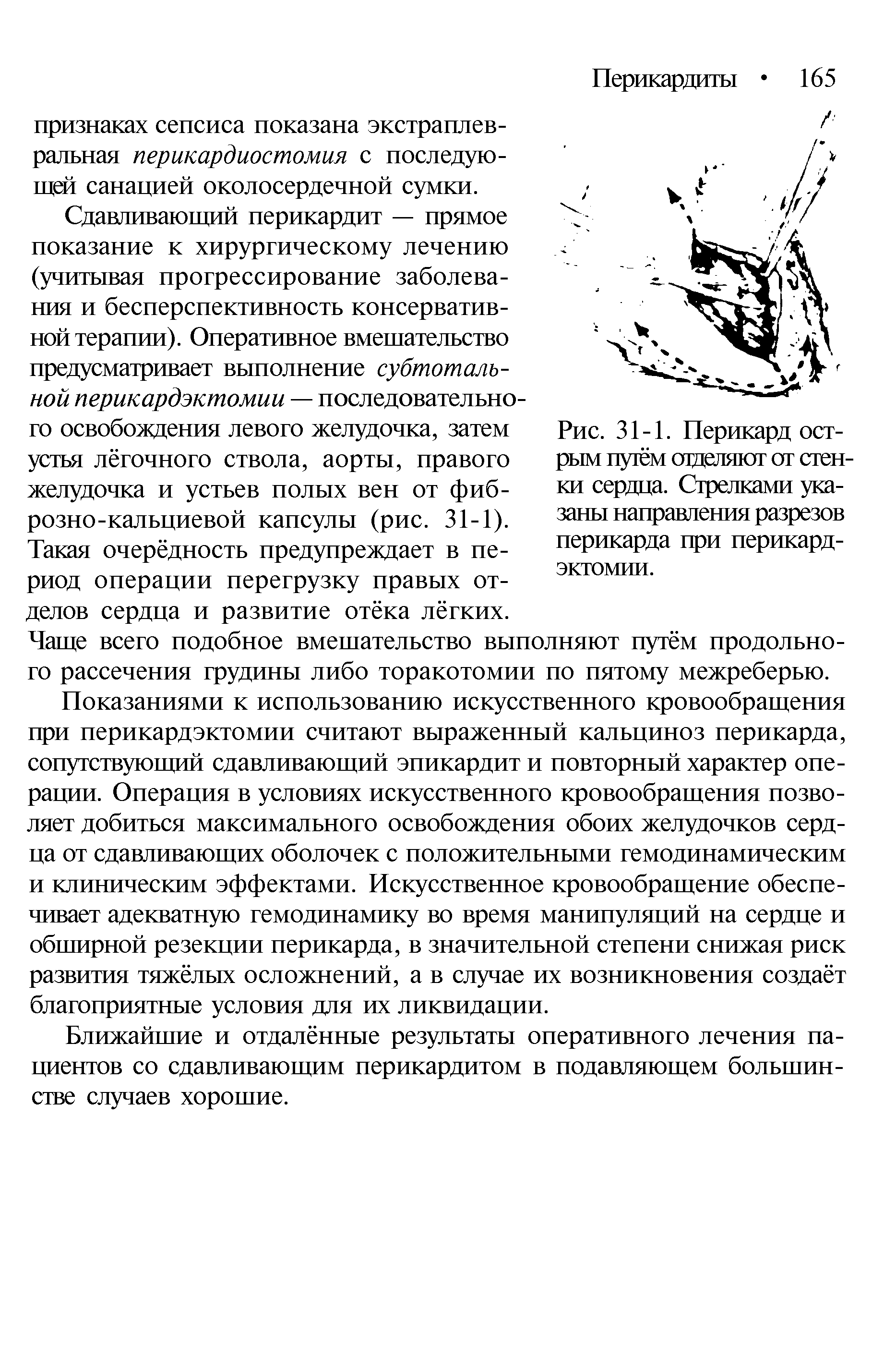 Рис. 31-1. Перикард острым путем отделяют от стенки сердца. Стрелками указаны направления разрезов перикарда при перикардэктомии.