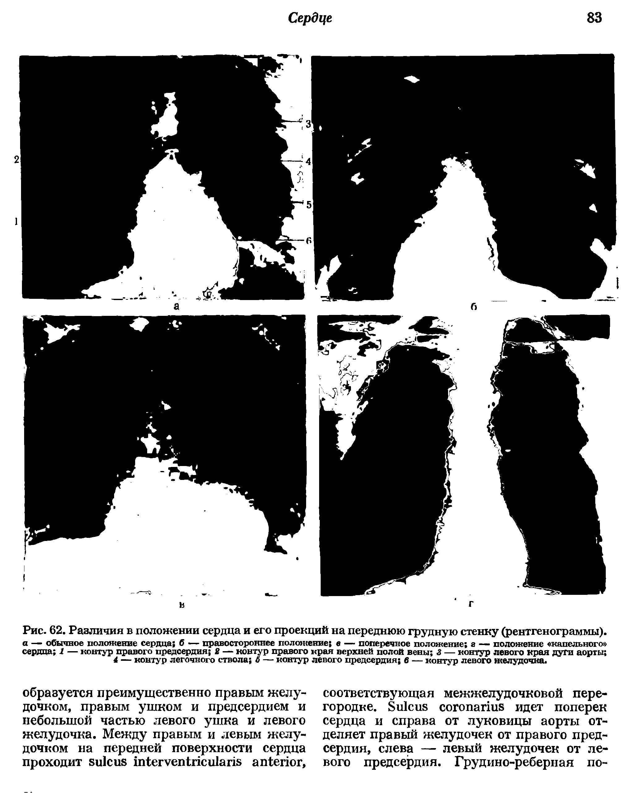 Рис. 62. Различия в положении сердца и его проекций на переднюю грудную стенку (рентгенограммы), а — обычное положение сердца б — правостороннее положение в — поперечное положение г — положение капельного сердца 1 — контур правого предсердия 2 — контур правого края верхней полой вены 3 — контур левого края дуги аорты ...