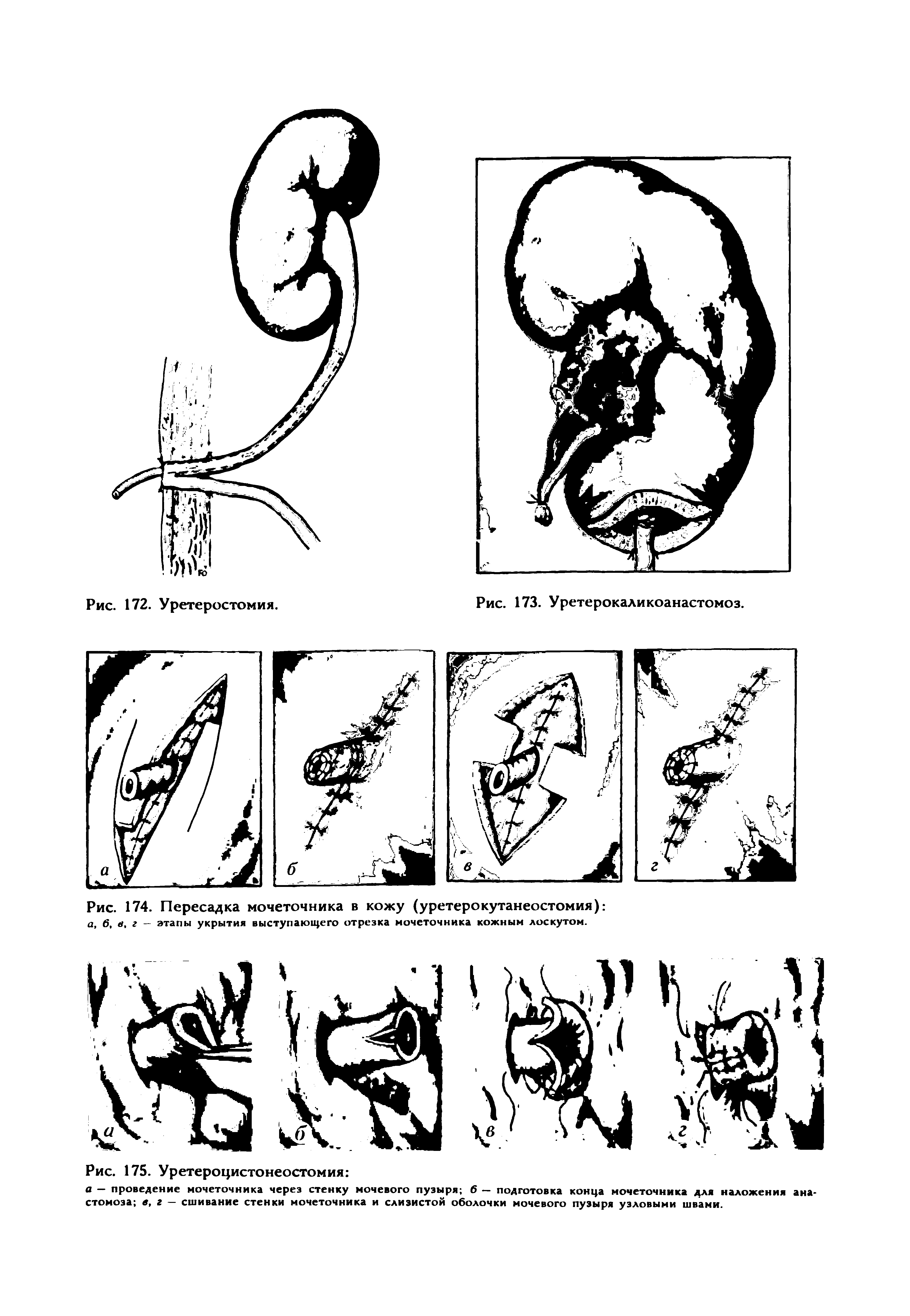 Рис. 174. Пересадка мочеточника в кожу (уретерокутанеостомия) а, 6, в, г — этапы укрытия выступающего отрезка мочеточника кожным лоскутом.