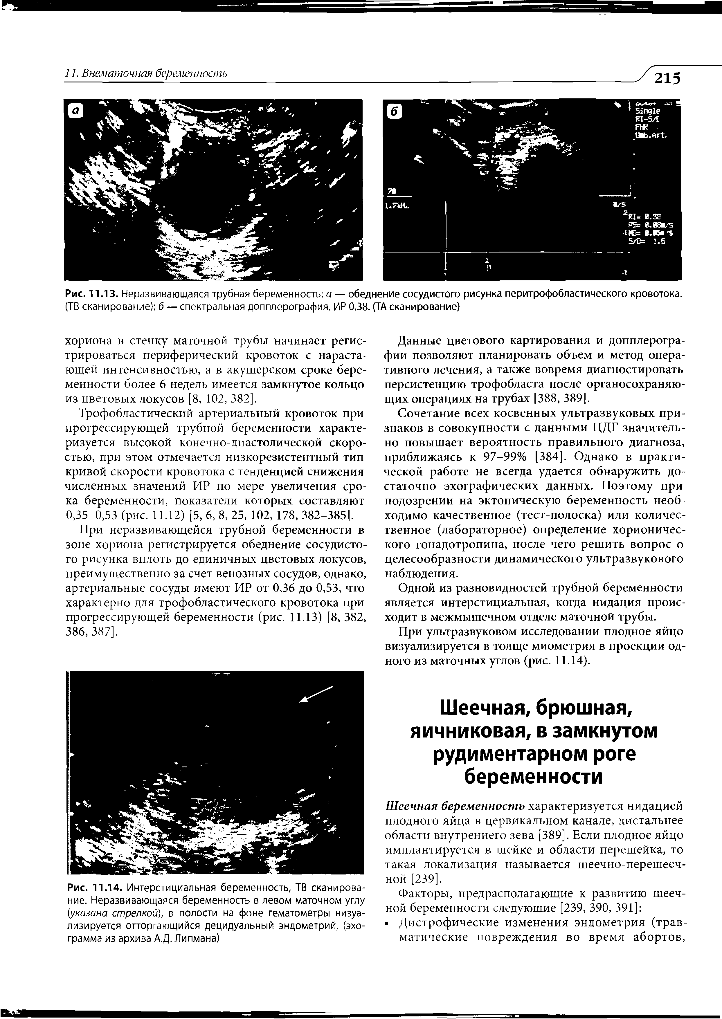 Рис. 11.14. Интерстициальная беременность, ТВ сканирование. Неразвивающаяся беременность в левом маточном углу (указана стрелкой), в полости на фоне гематометры визуализируется отторгающийся децидуальный эндометрий, (эхограмма из архива А.Д. Липмана)...