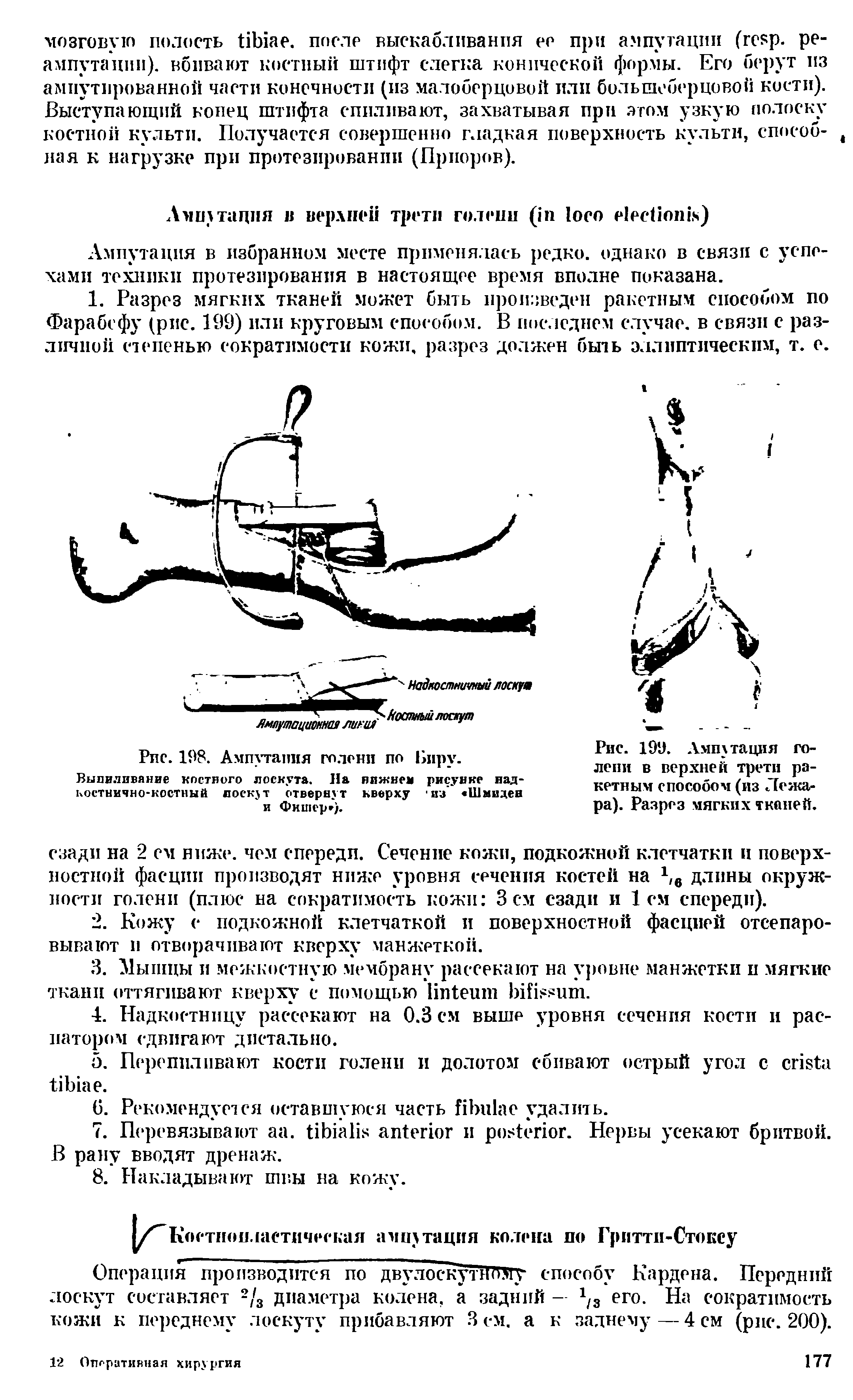 Рис. 199. Ампутация голени в верхней трети ракетным способом (из Лежат ра). Разрез мягких тканей.