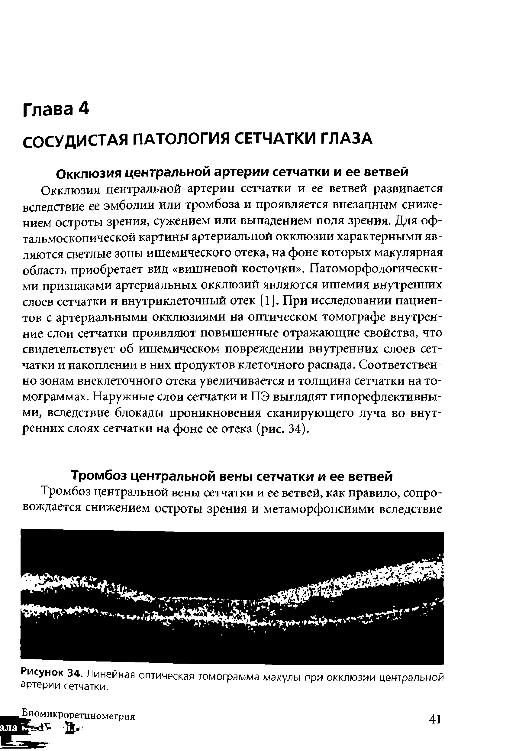 Рисунок 34. Линейная оптическая томограмма макулы при окклюзии центральной артерии сетчатки.