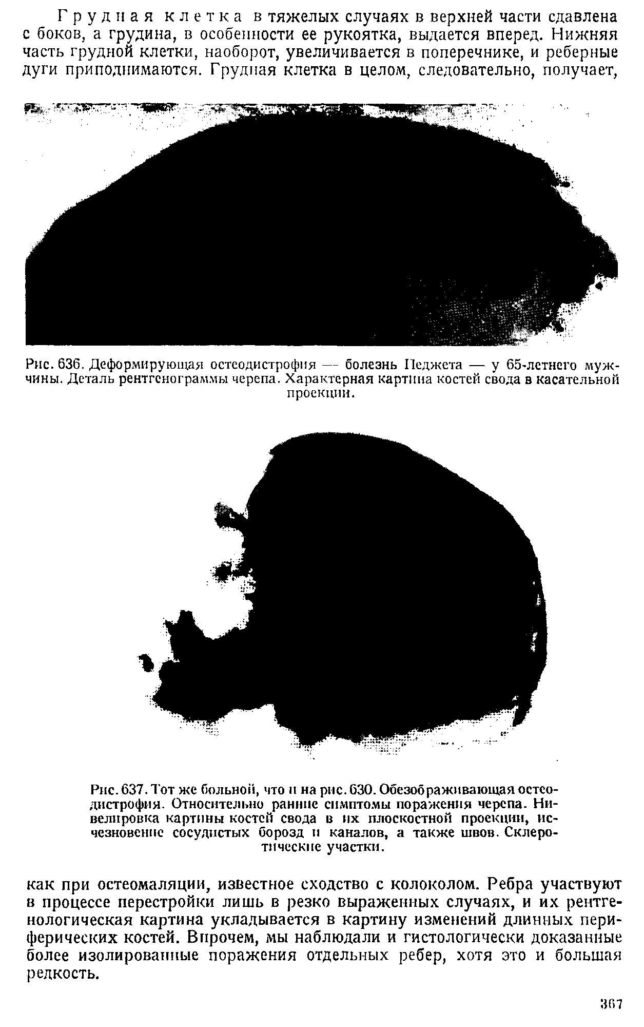 Рис. 637. Тот же больной, что и на рис. 630. Обезображивающая остеодистрофия. Относительно ранние симптомы поражения черепа. Нивелировка картины костей свода в их плоскостной проекции, исчезновение сосудистых борозд и каналов, а также швов. Склеротические участки.