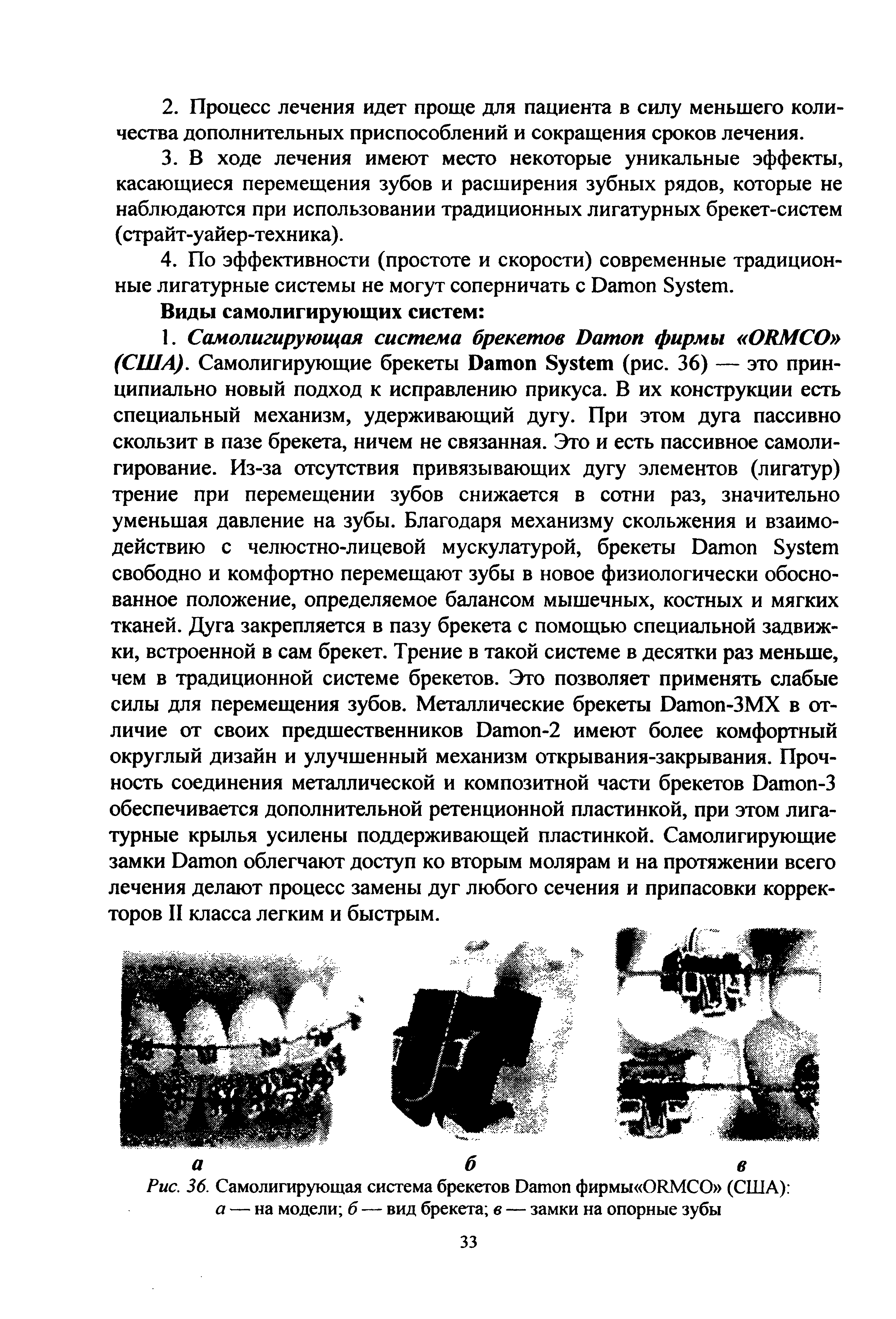 Рис. 36. Самолигирующая система брекетов D фирмы (ЖМСО (США) а — на модели б — вид брекета в — замки на опорные зубы...