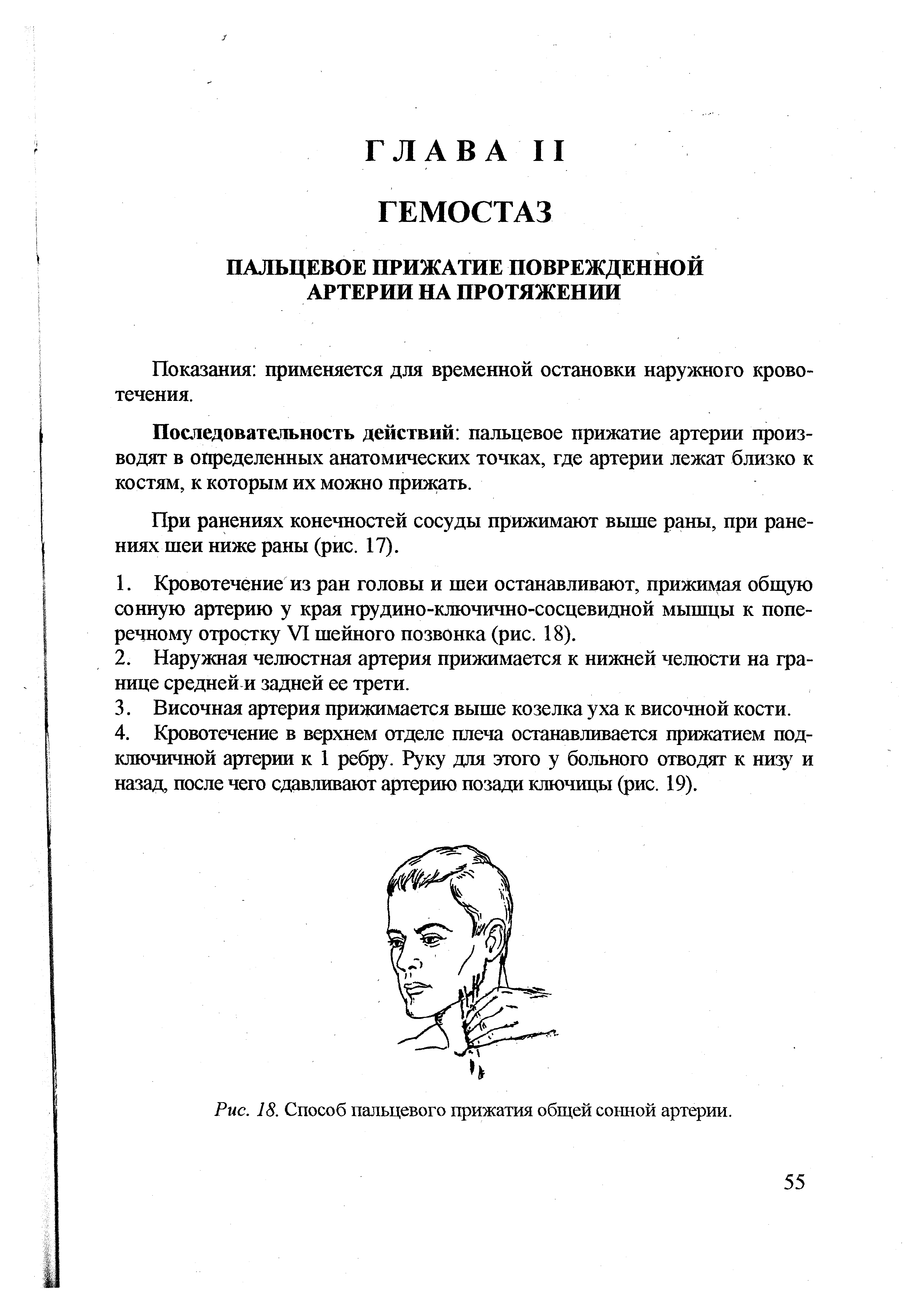 Рис. 18. Способ пальцевого прижатия общей сонной артерии.