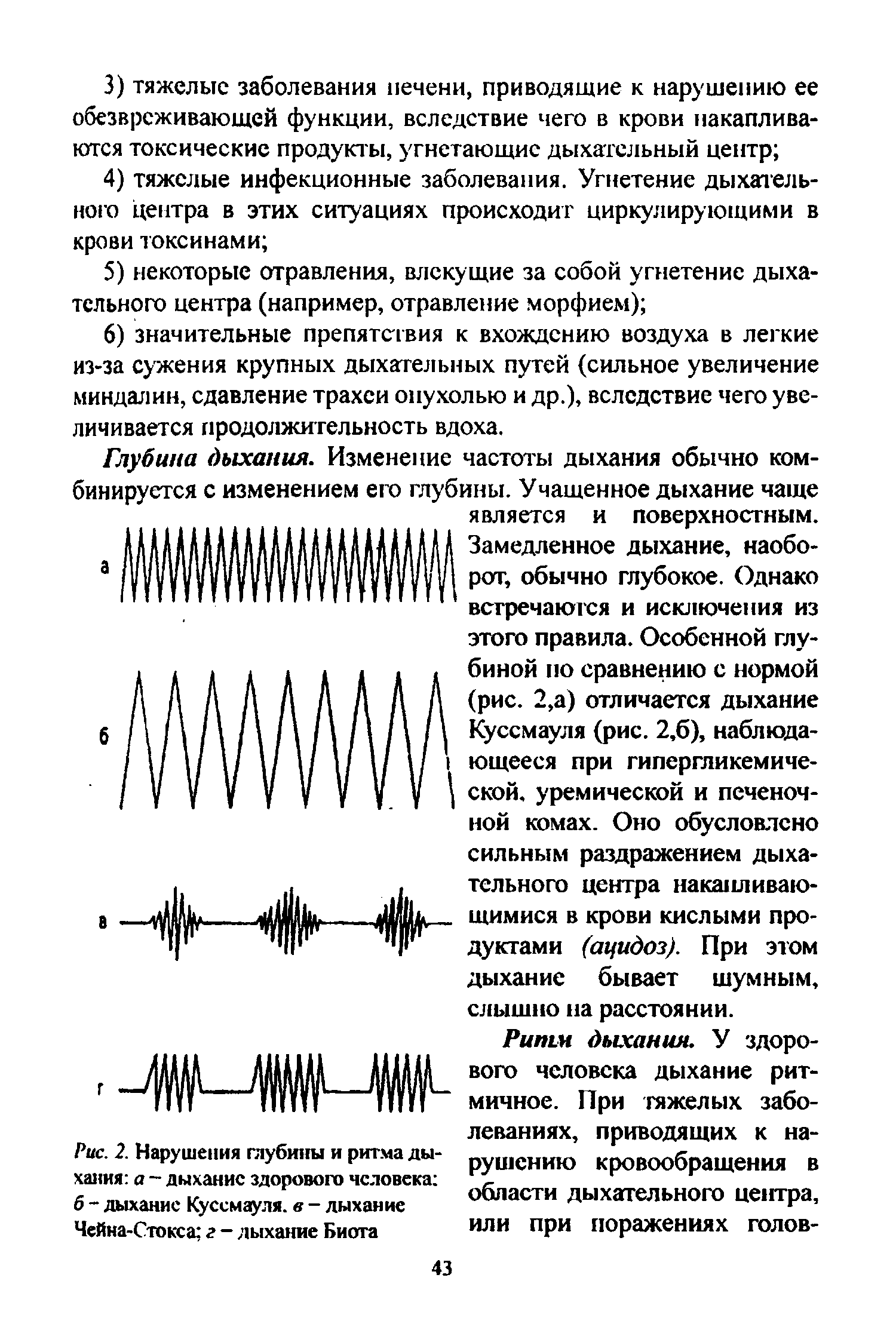 Рис. 2. Нарушения глубины и ритма дыхания а - дыхание здорового человека 6 - дыхание Куссмауля. в - дыхание Чейна-Стокса г - дыхание Биота...