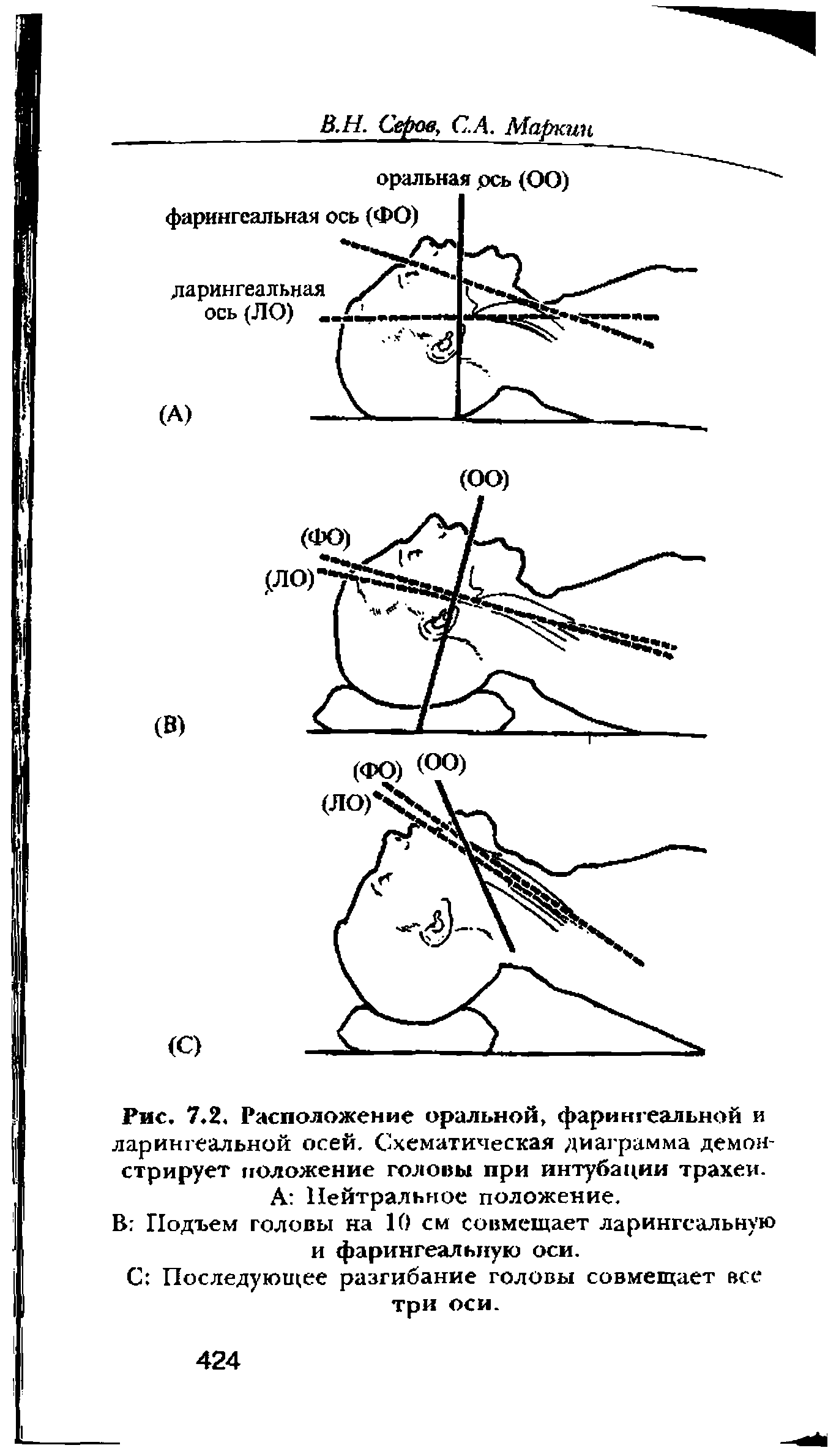 Рис. 7.2. Расположение оральной, фарингеальной и ларингеальной осей. Схематическая диаграмма демонстрирует положение головы при интубации трахеи. А Нейтральное положение.