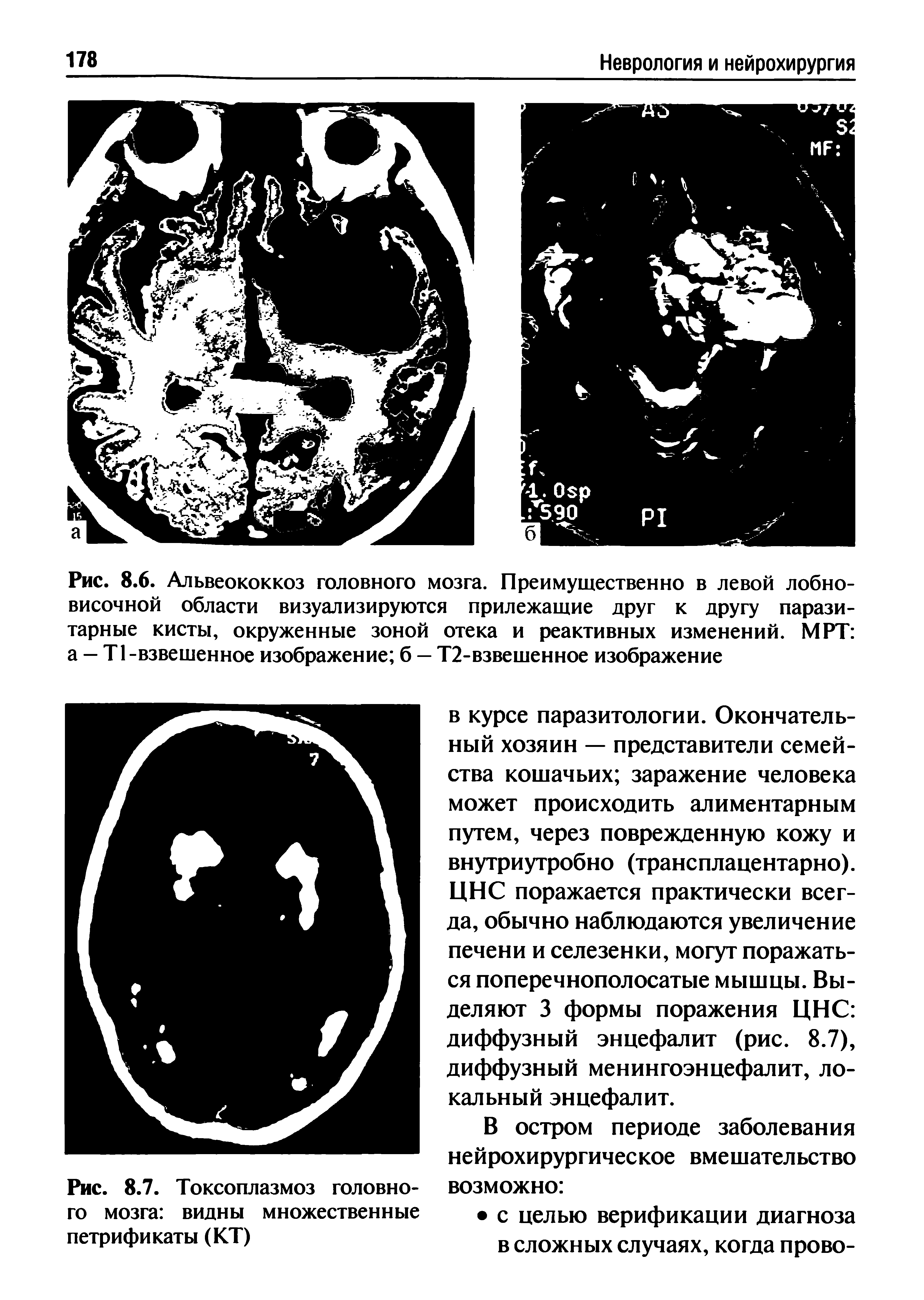 Рис. 8.7. Токсоплазмоз головного мозга видны множественные петрификаты (КТ)...