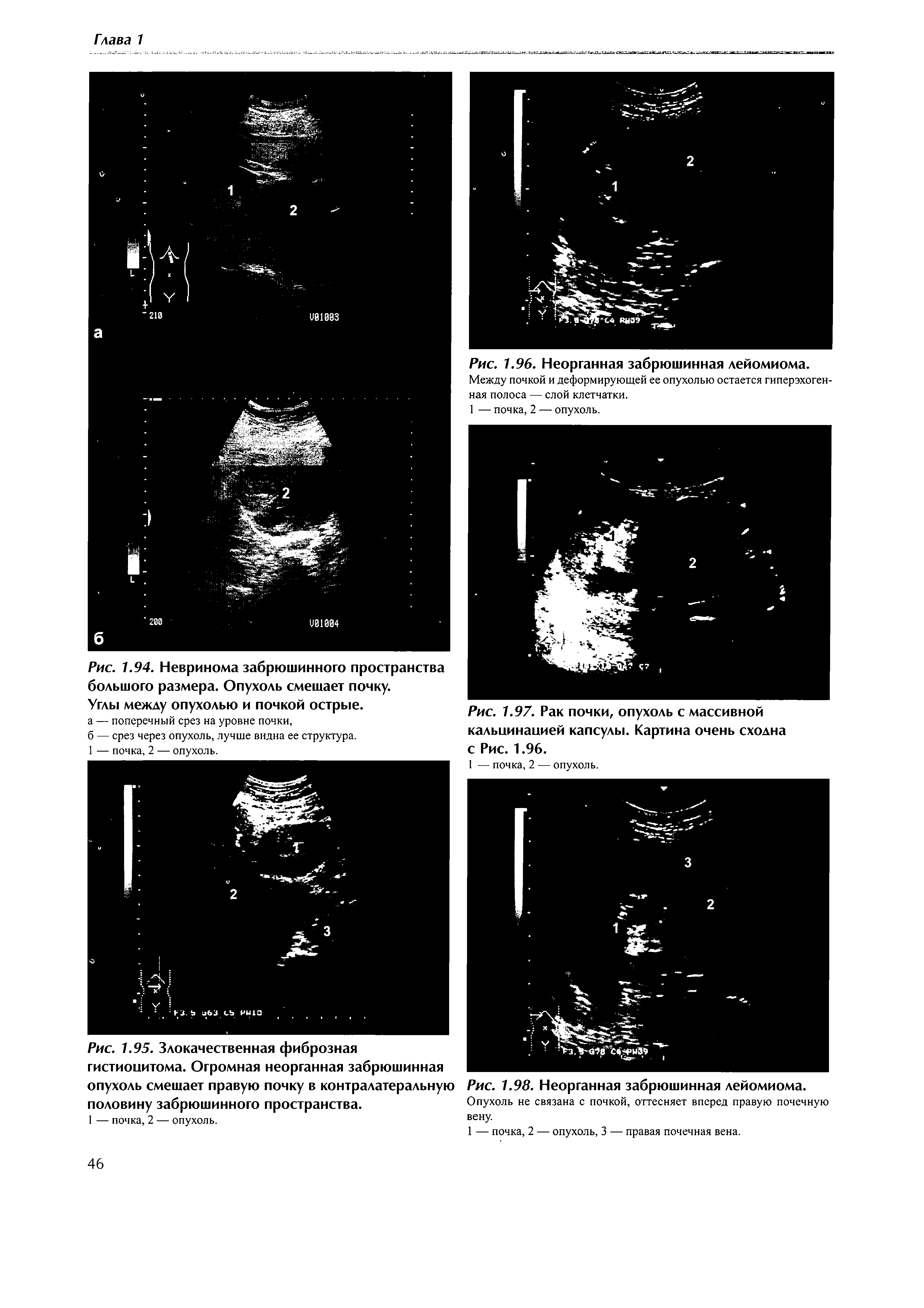 Рис. 1.95. Злокачественная фиброзная гистиоцитома. Огромная неорганная забрюшинная опухоль смешает правую почку в контралатеральную половину забрюшинного пространства.