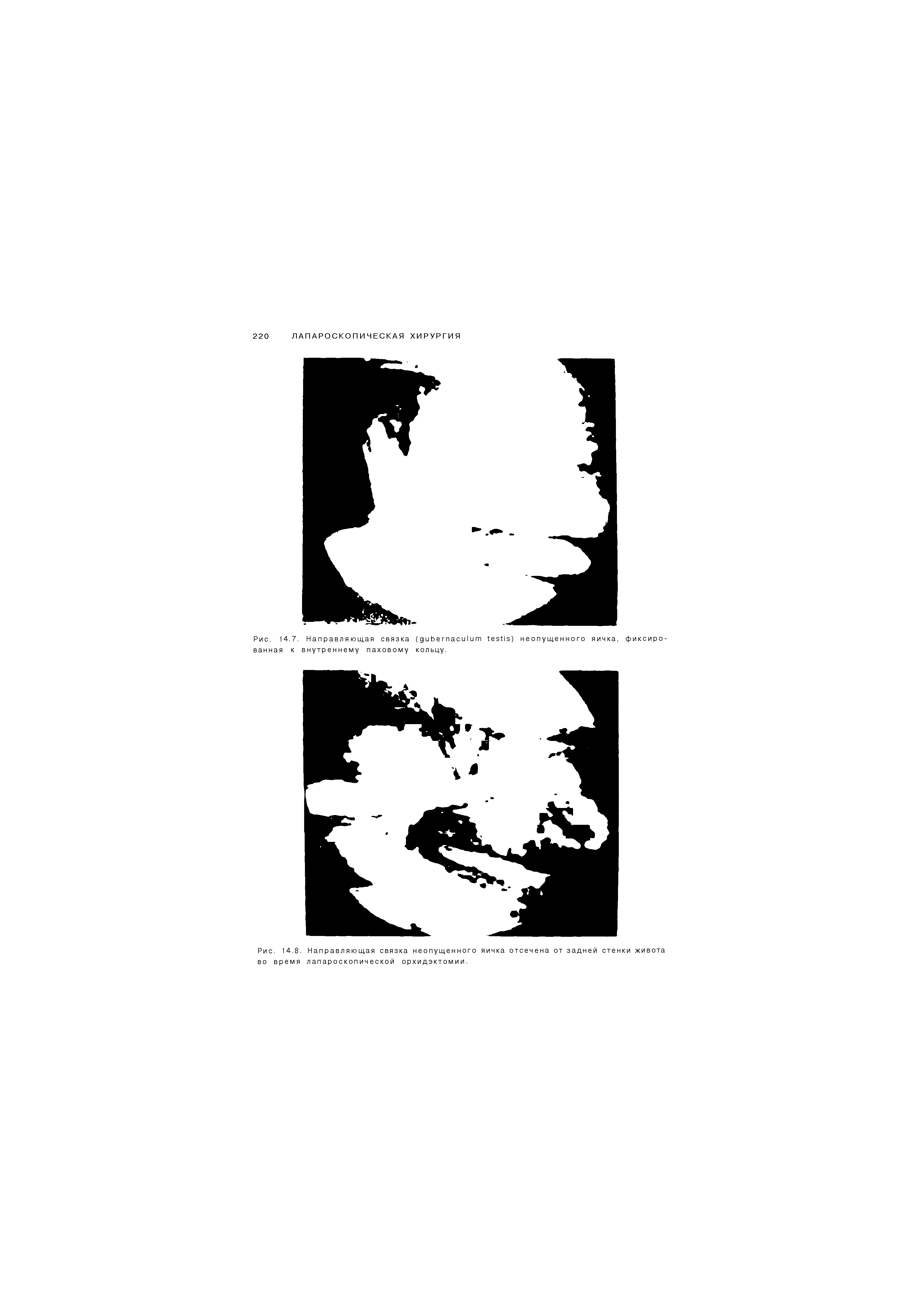 Рис. 14.7. Направляющая связка ( ) неопущенного яичка, фиксированная к внутреннему паховому кольцу.