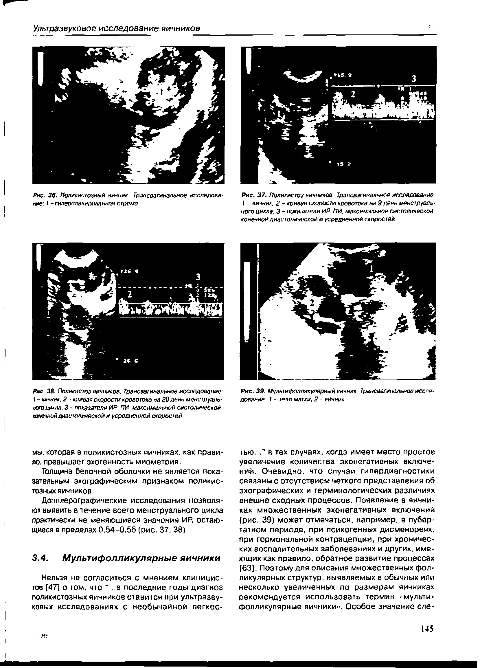 Рис. 39. Мультифолликулярный яичник рансаагинальное исследование Г - тело матки. 2 - яинник...